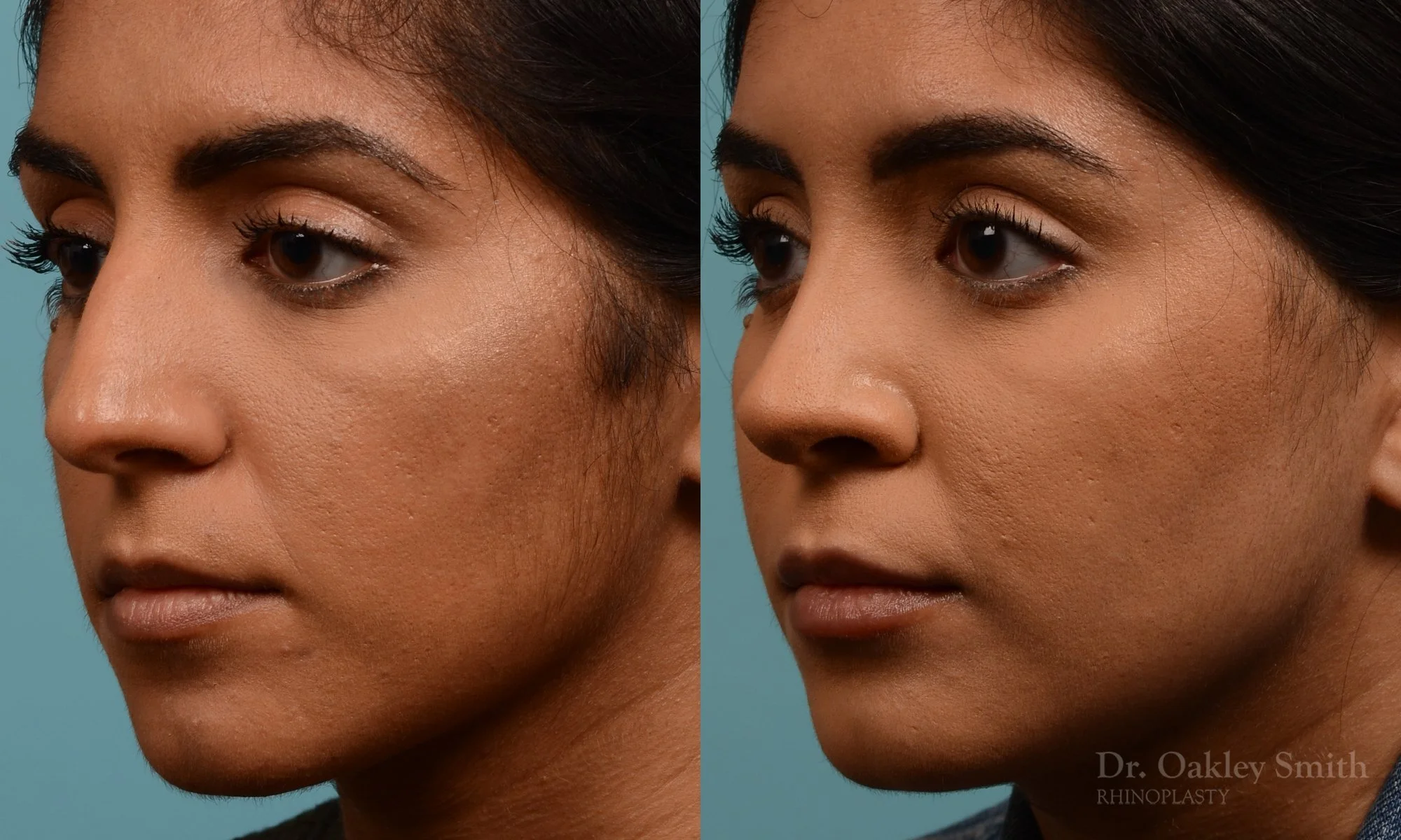 303.1D-rhinoplasty-dr-oakley-smith-toronto-nose-job.jpg