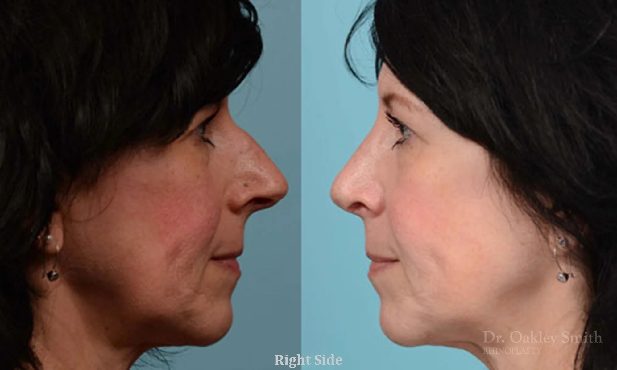324C-rhinoplasty-dr-oakley-smith-toronto-nose-job.jpg