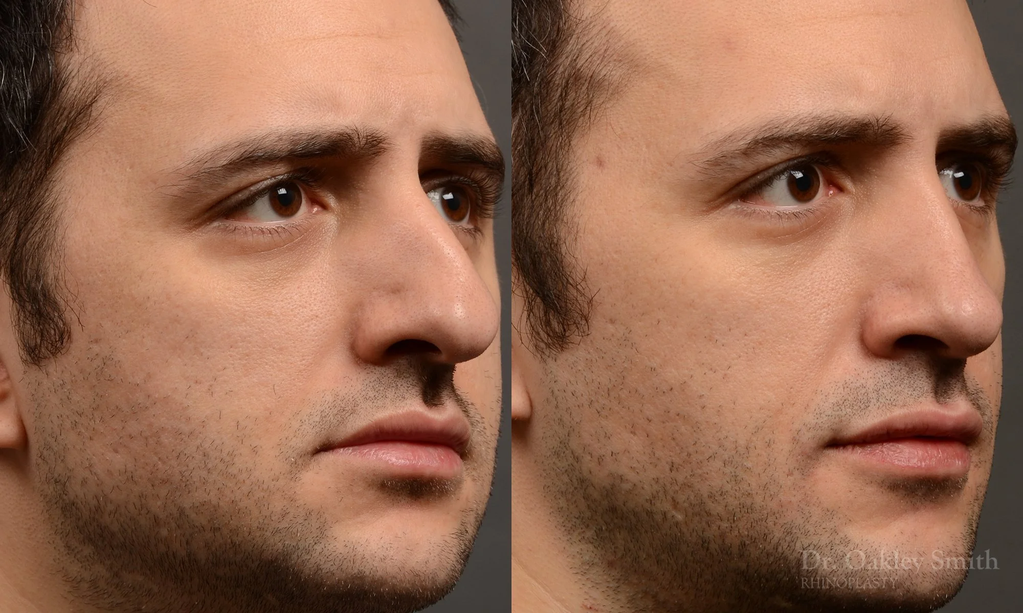 428B-male-rhinoplasty-dr-oakley-smith-toronto-top-surgeon-nose-job.jpg