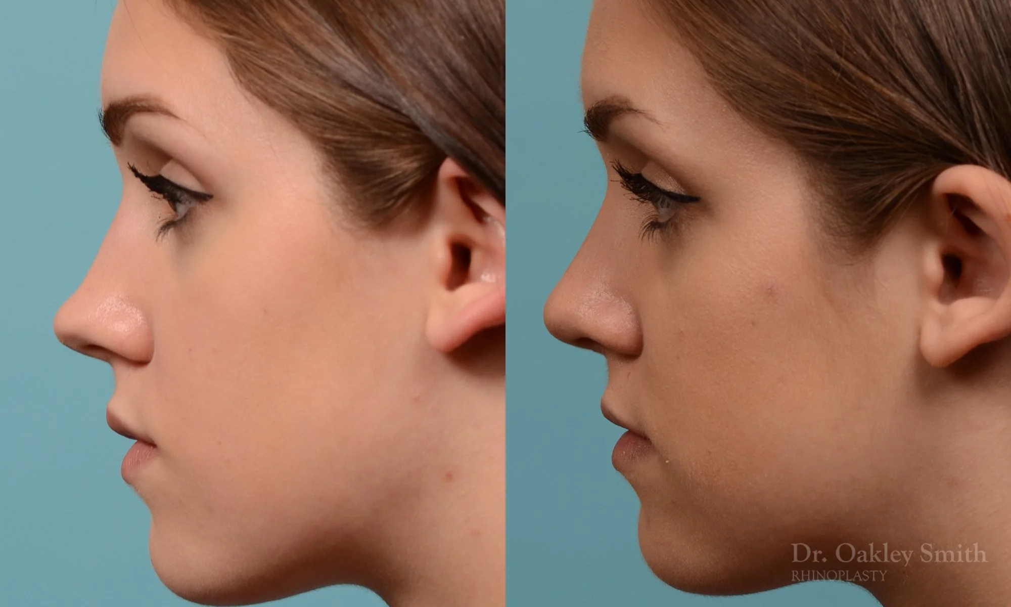 293E-rhinoplasty-dr-oakley-smith-toronto-nose-job.jpg
