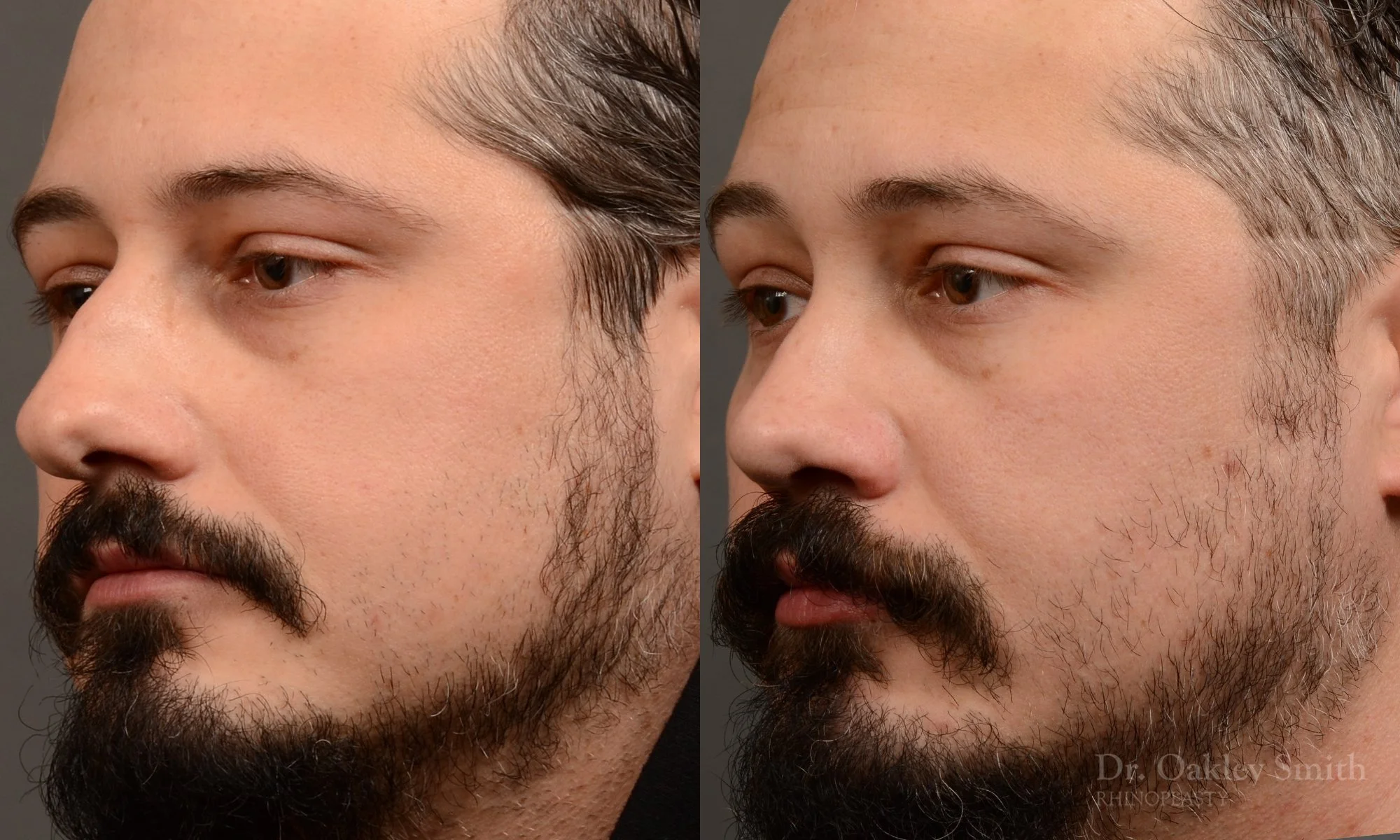 501D-male-rhinoplasty-dr-oakley-smith-toronto-top-surgeon-nose-job.jpg