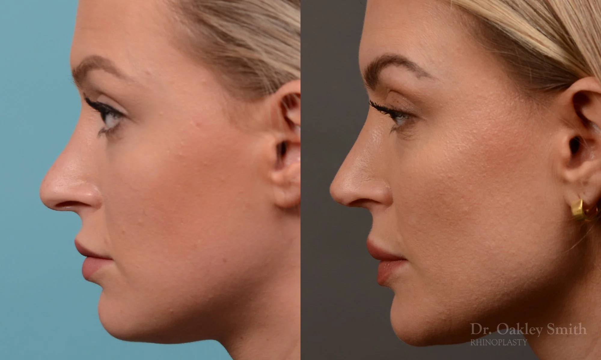 538E-rhinoplasty-dr-oakley-smith-toronto-nose-job.jpg