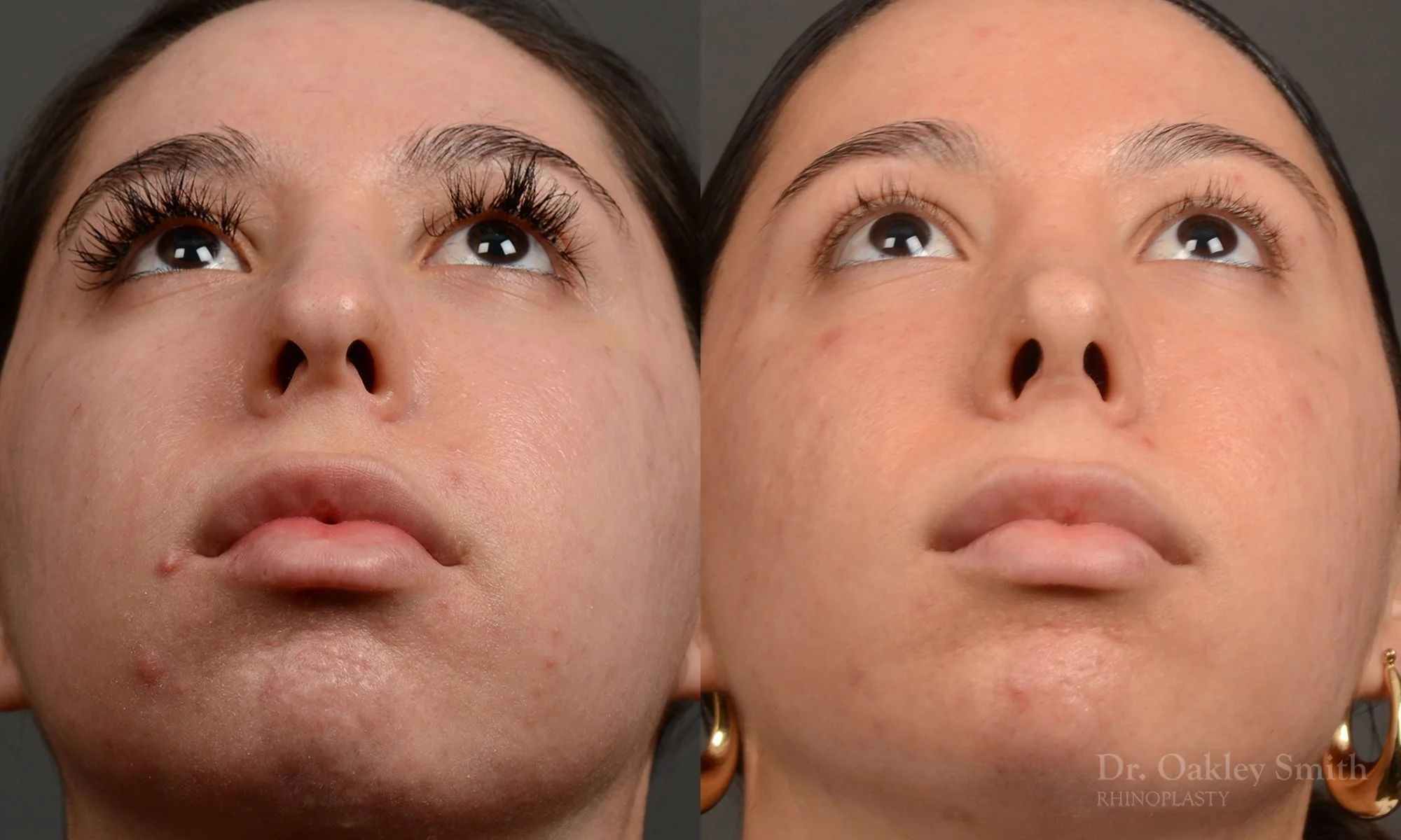 486F-rhinoplasty-dr-oakley-smith-toronto-top-surgeon-nose-job.jpg