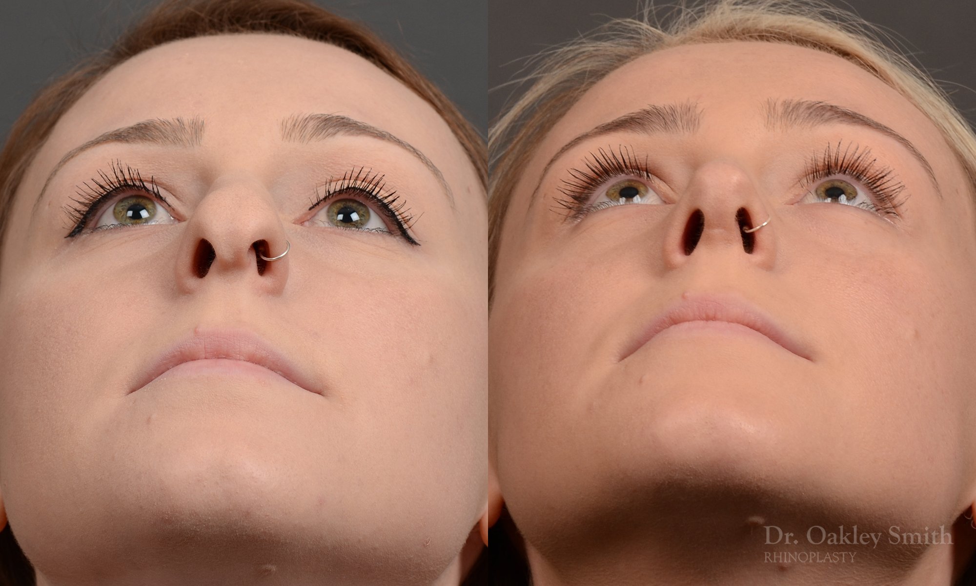 477F-rhinoplasty-dr-oakley-smith-toronto-top-surgeon-nose-job.jpg