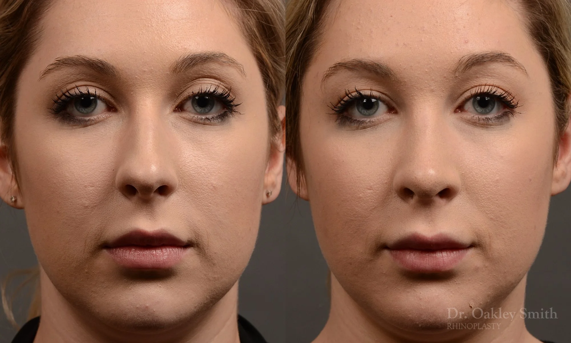 348A-rhinoplasty-dr-oakley-smith-toronto-nose-job.jpg