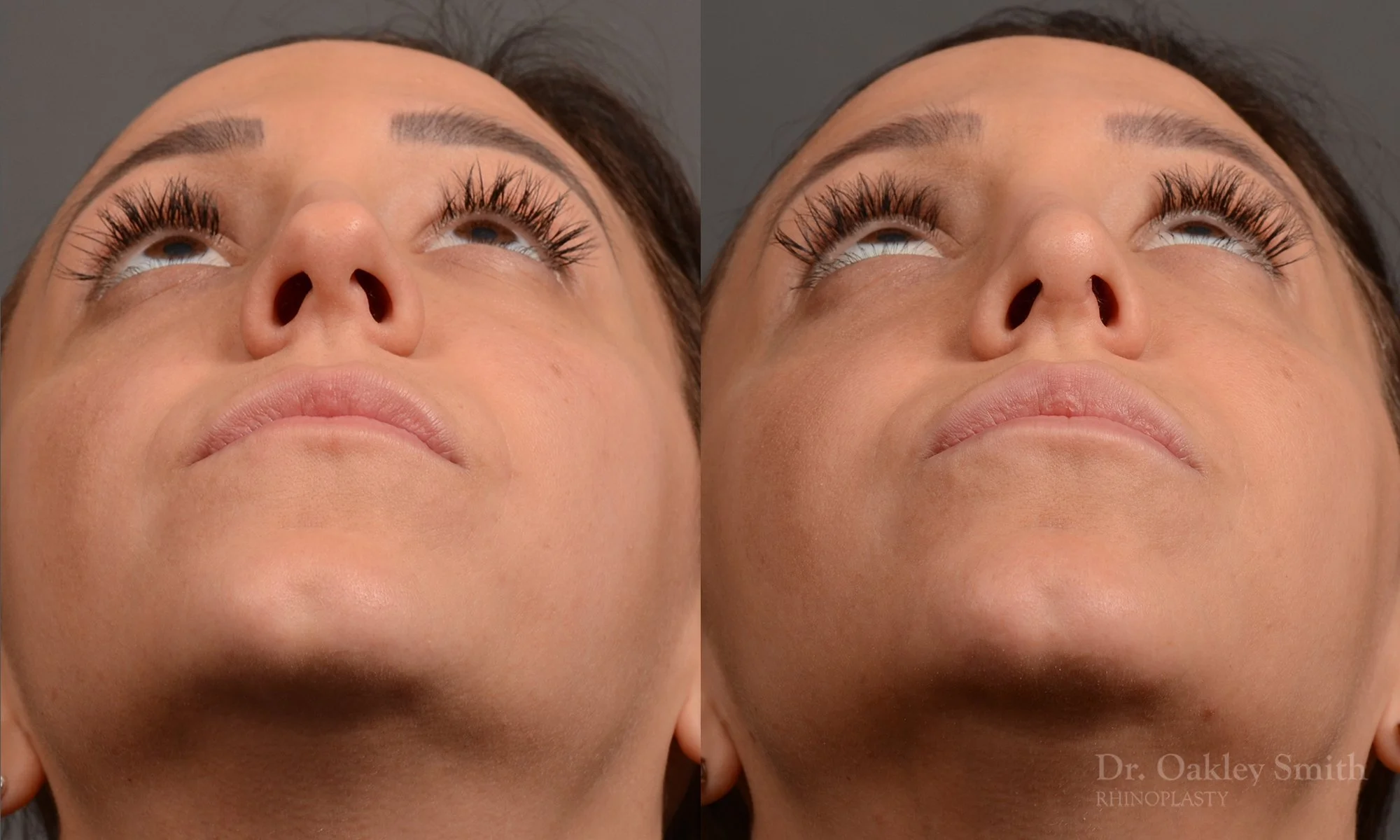 353F-rhinoplasty-dr-oakley-smith-toronto-nose-job.jpg