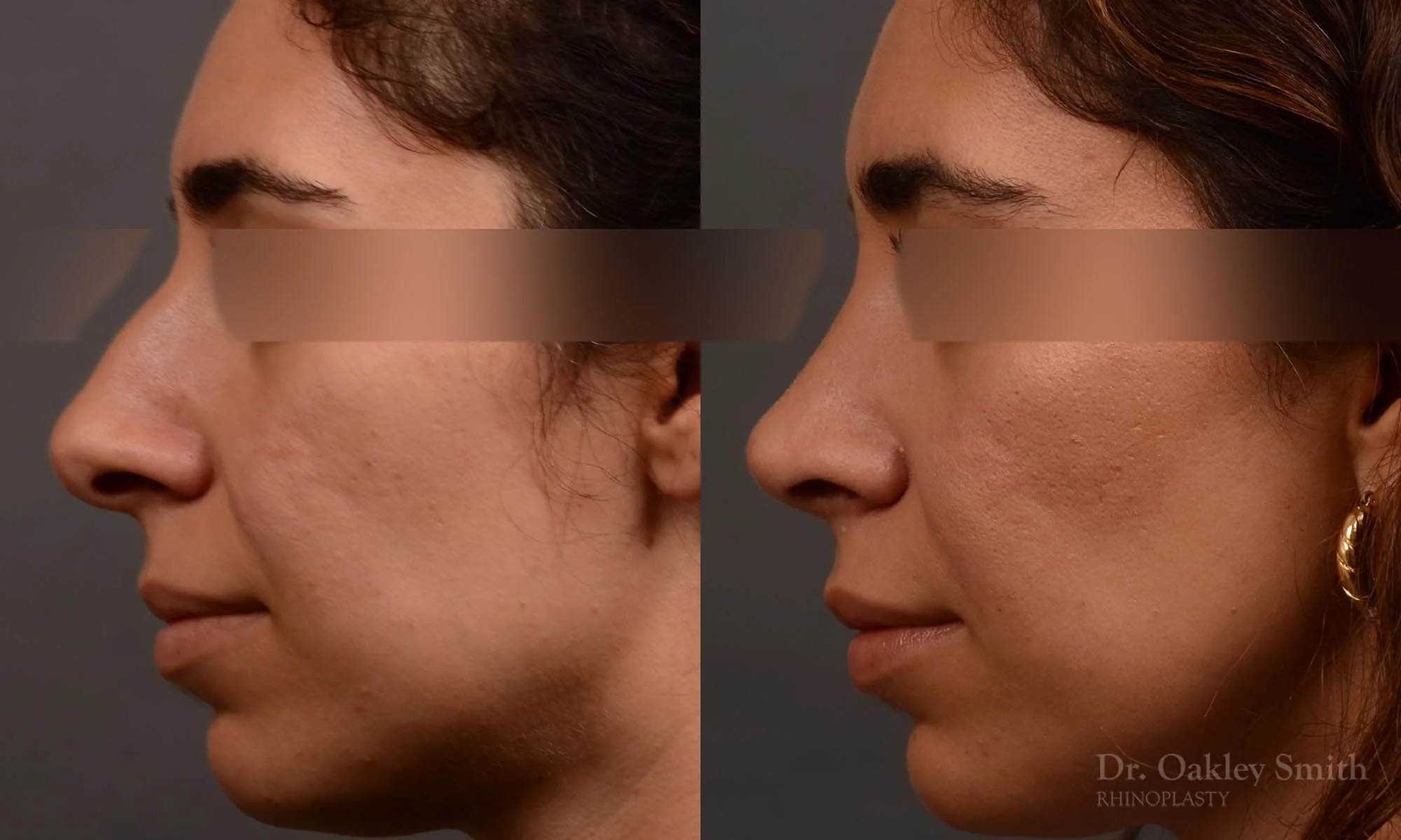 488E-rrhinoplasty-dr-oakley-smith-toronto-top-surgeon-nose-job.jpg