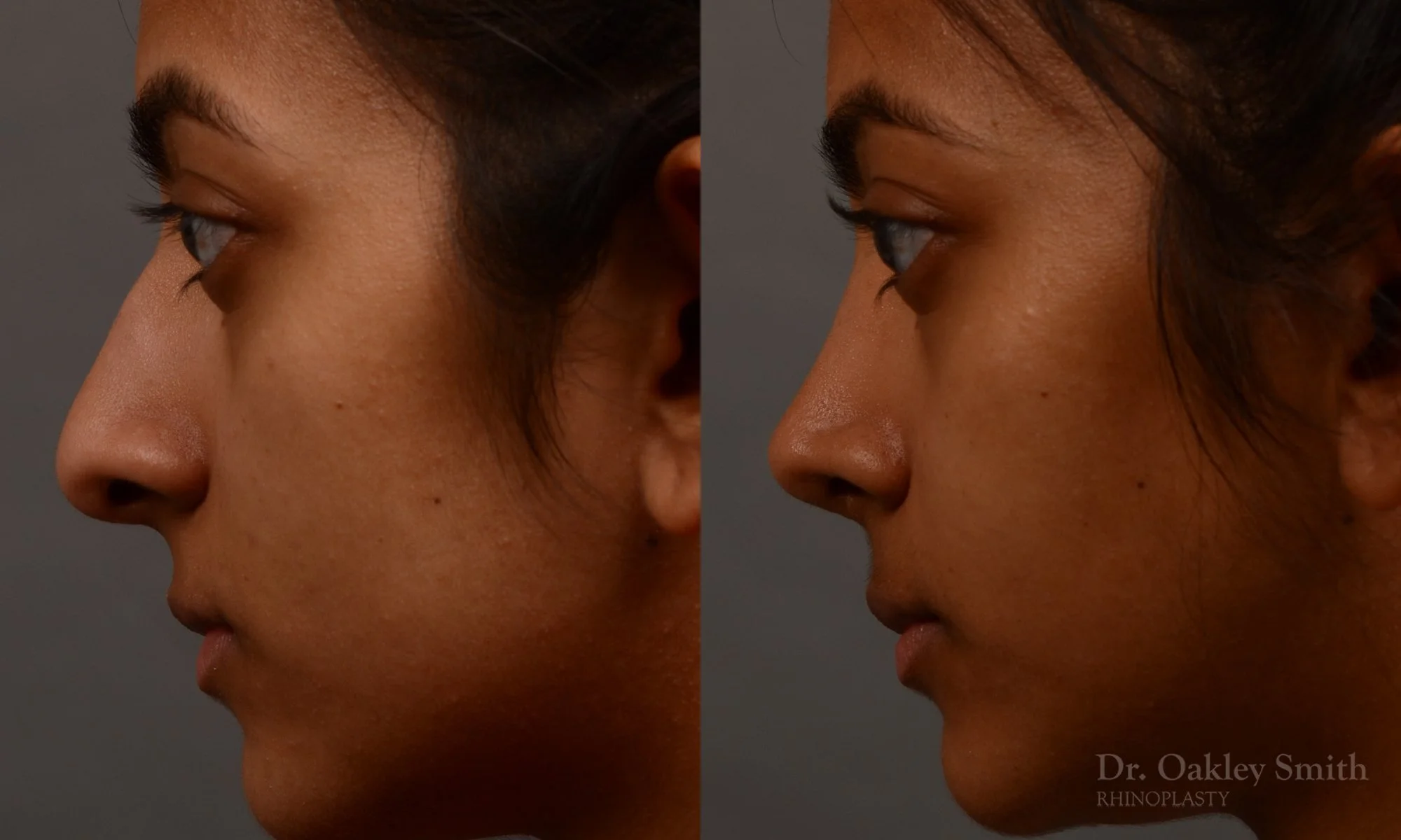 399E-expert-rhinoplasty-dr-oakley-smith-toronto-nose-job.jpg