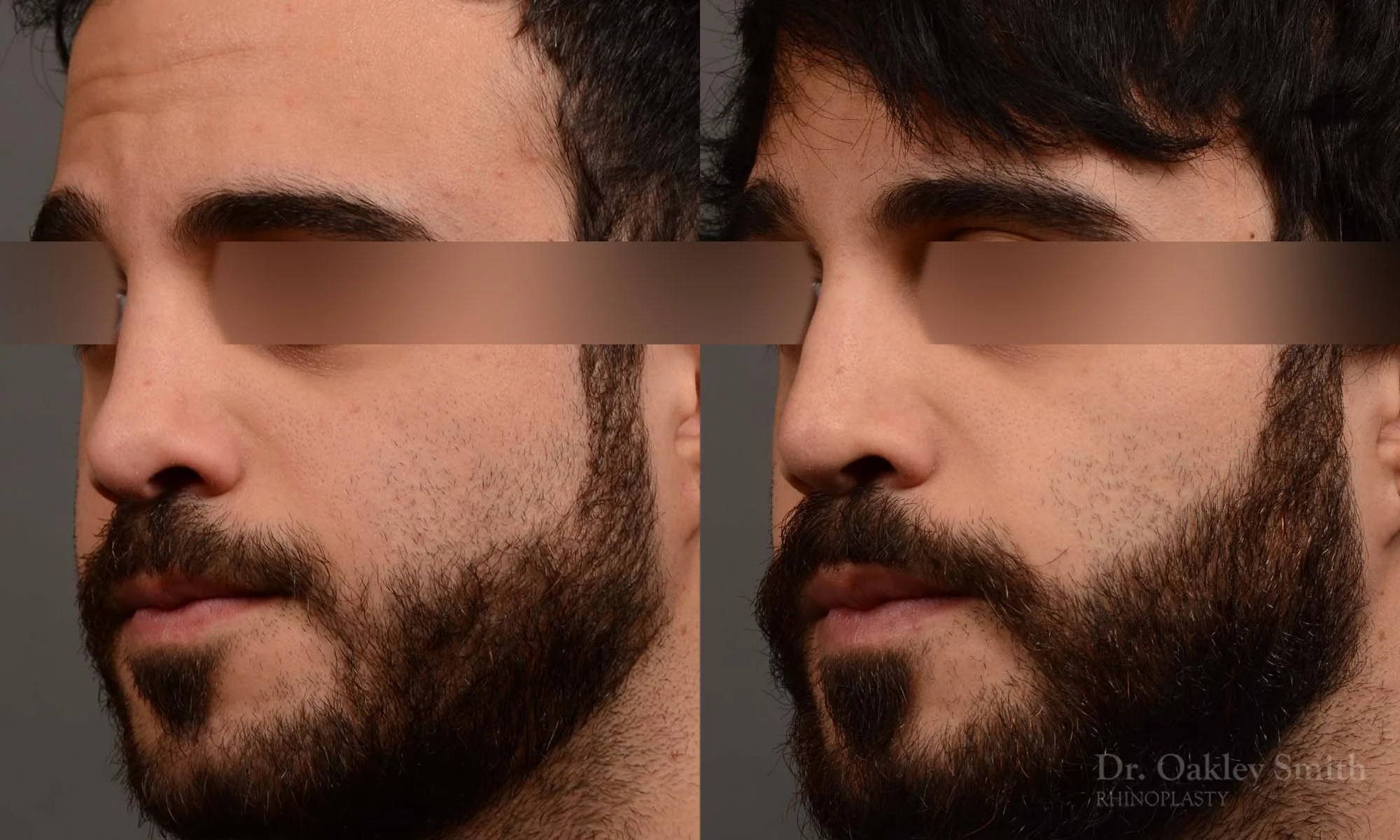 327.1D-rhinoplasty-dr-oakley-smith-toronto-nose-job.jpg
