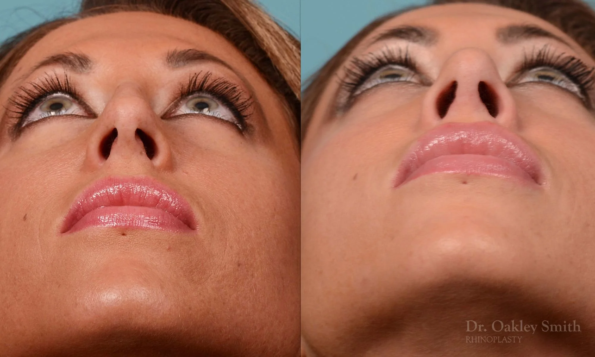 208F-watermark-rhinoplasty-toronto-dr-oakley-smith-female-nose-job-nose-job-big-nose-bump-bridge-1 (1).jpg