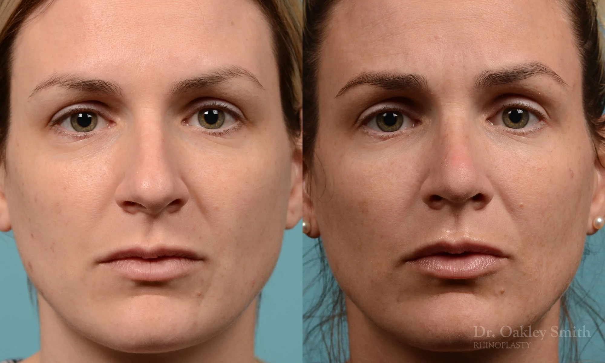 312A-rhinoplasty-dr-oakley-smith-toronto-nose-job.jpg