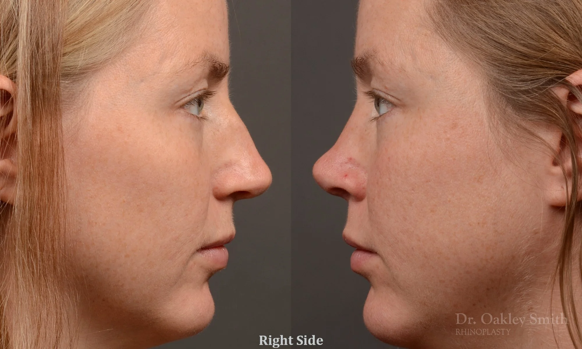 482C-rhinoplasty-dr-oakley-smith-toronto-top-surgeon-nose-job-1.jpg