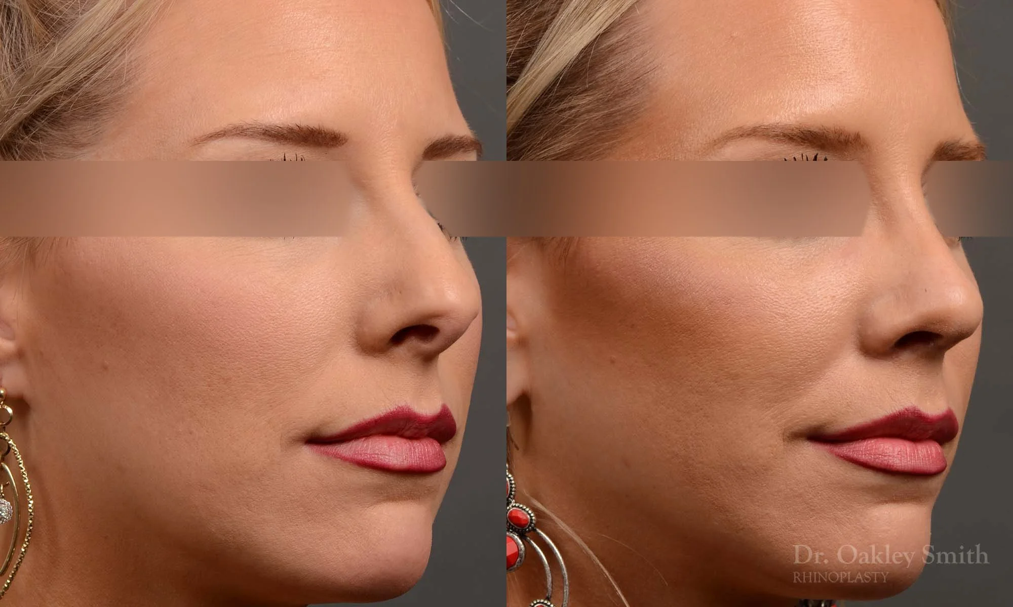 307B-rhinoplasty-dr-oakley-smith-nose-job-toronto.jpg