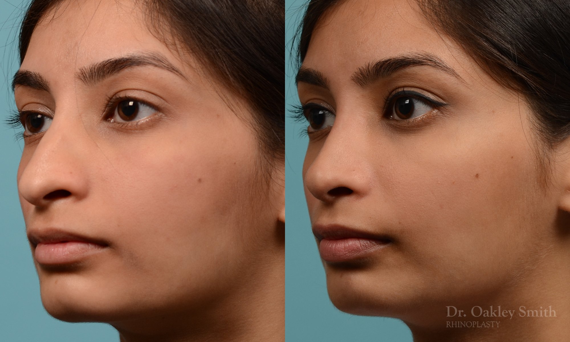 272.5D-rhinoplasty-dr-oakley-smith-toronto-nose-job.jpg