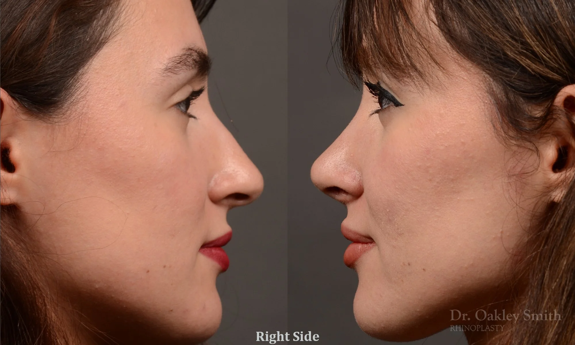 526C-rhinoplasty-dr-oakley-smith-toronto-top-surgeon-nose-job.jpg