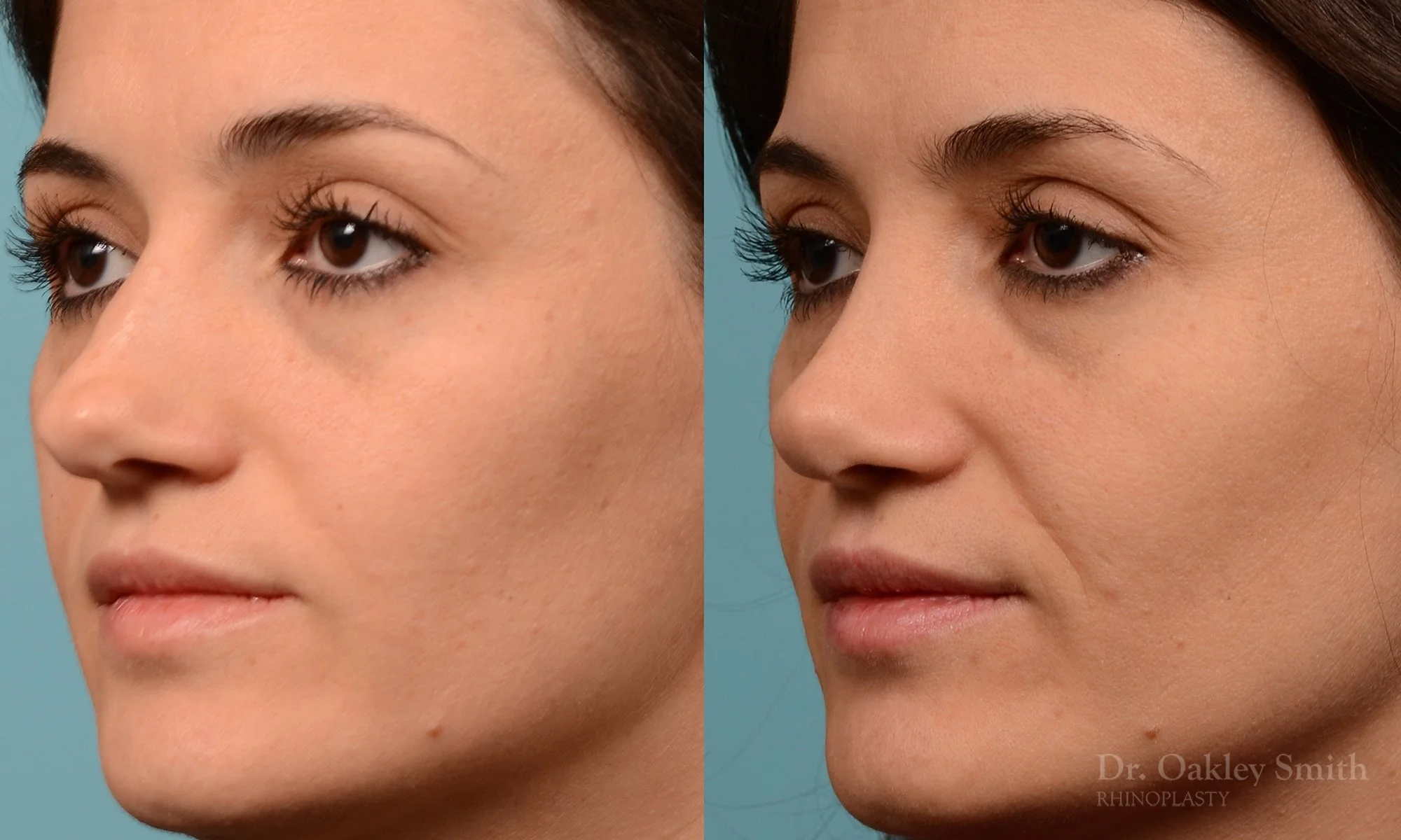 234D-nose-job-nose-reduction-rhinoplasty-pointy-nose-curved-nose-dr-oakley-smith-toronto.jpg