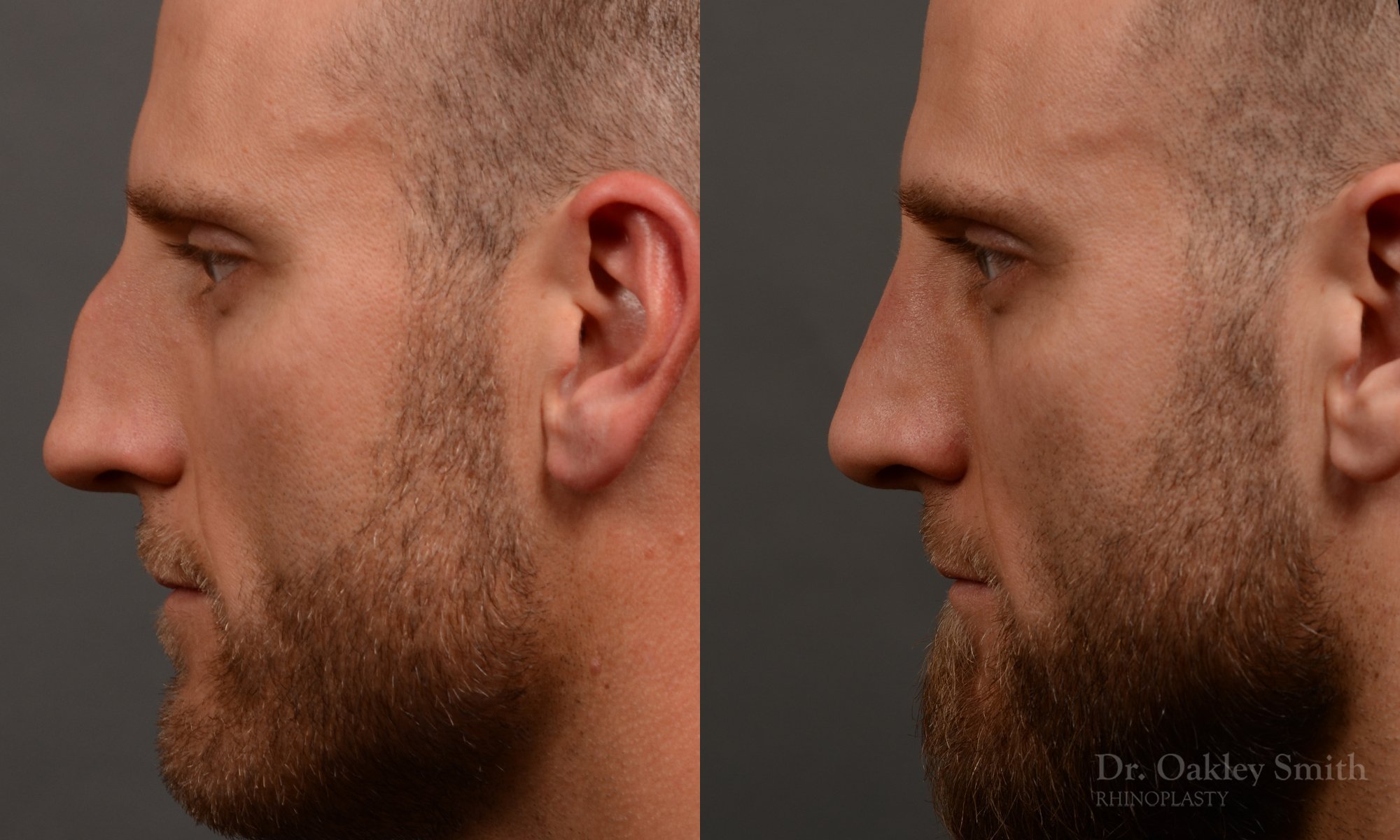 367.1E-rhinoplasty-dr-oakley-smith-toronto-male-nose-job.jpg