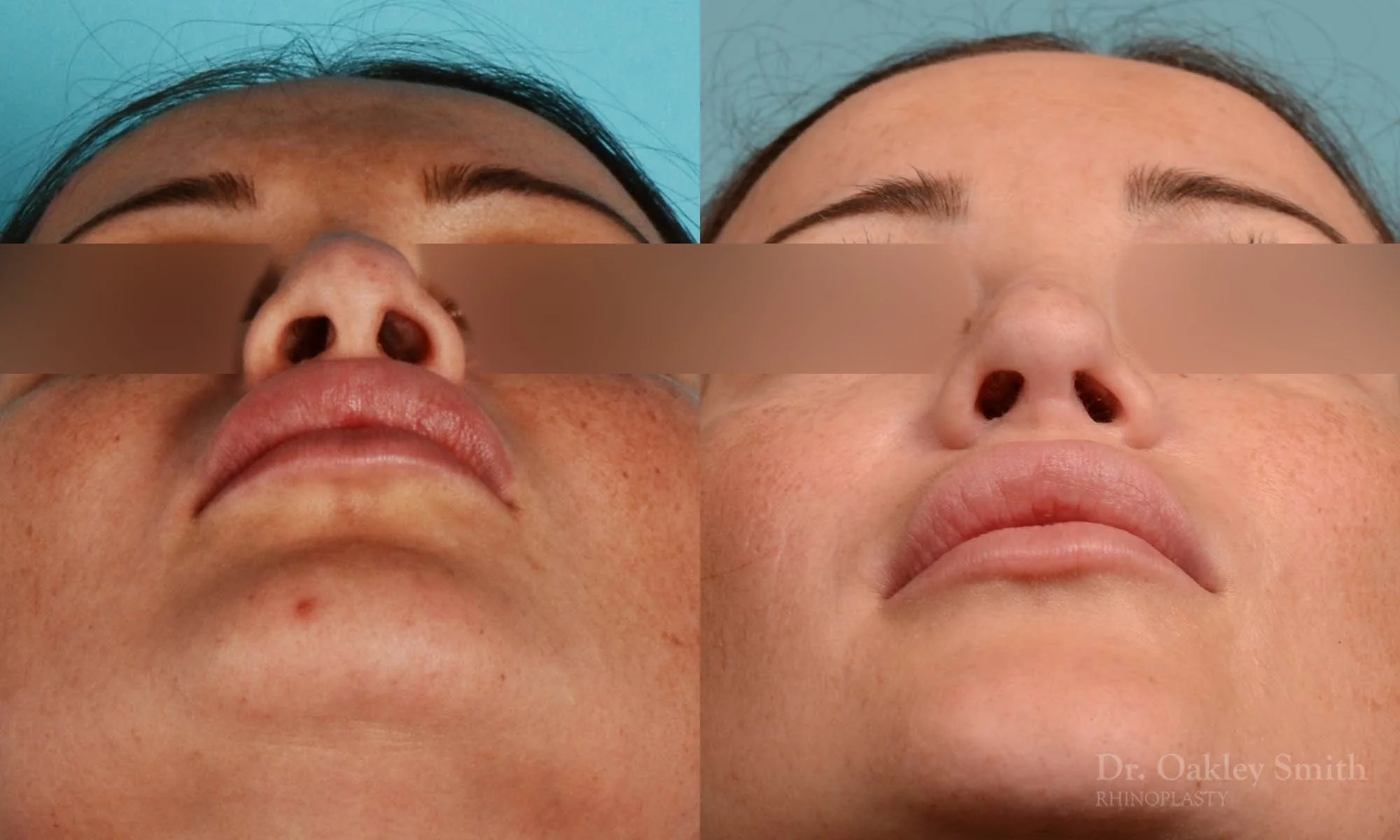 258F-rhinoplasty-dr-oakley-smith-toronto-nose-job.jpg
