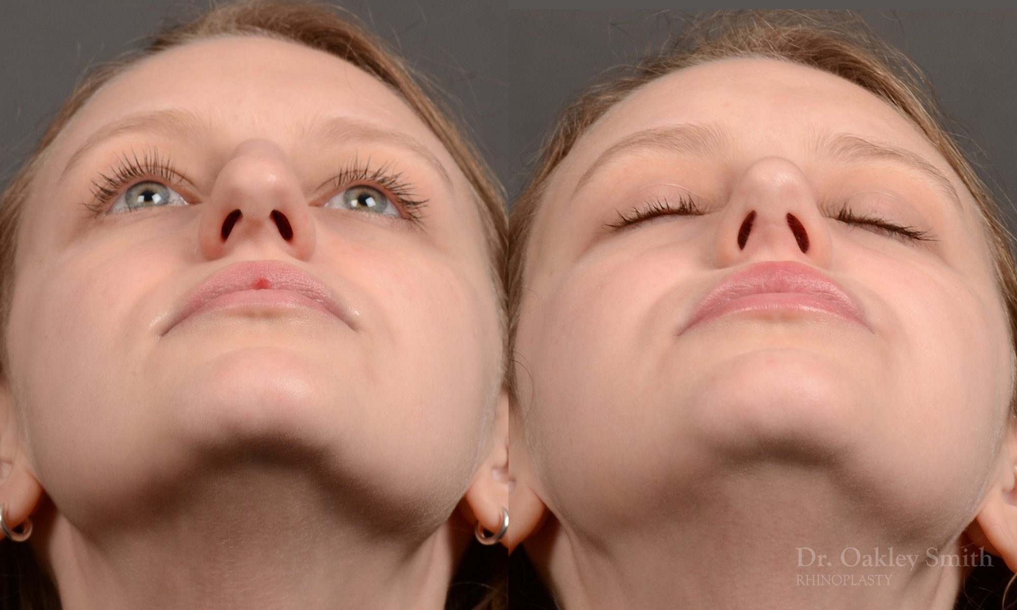 539F-rhinoplasty-dr-oakley-smith-toronto-nose-job.jpg
