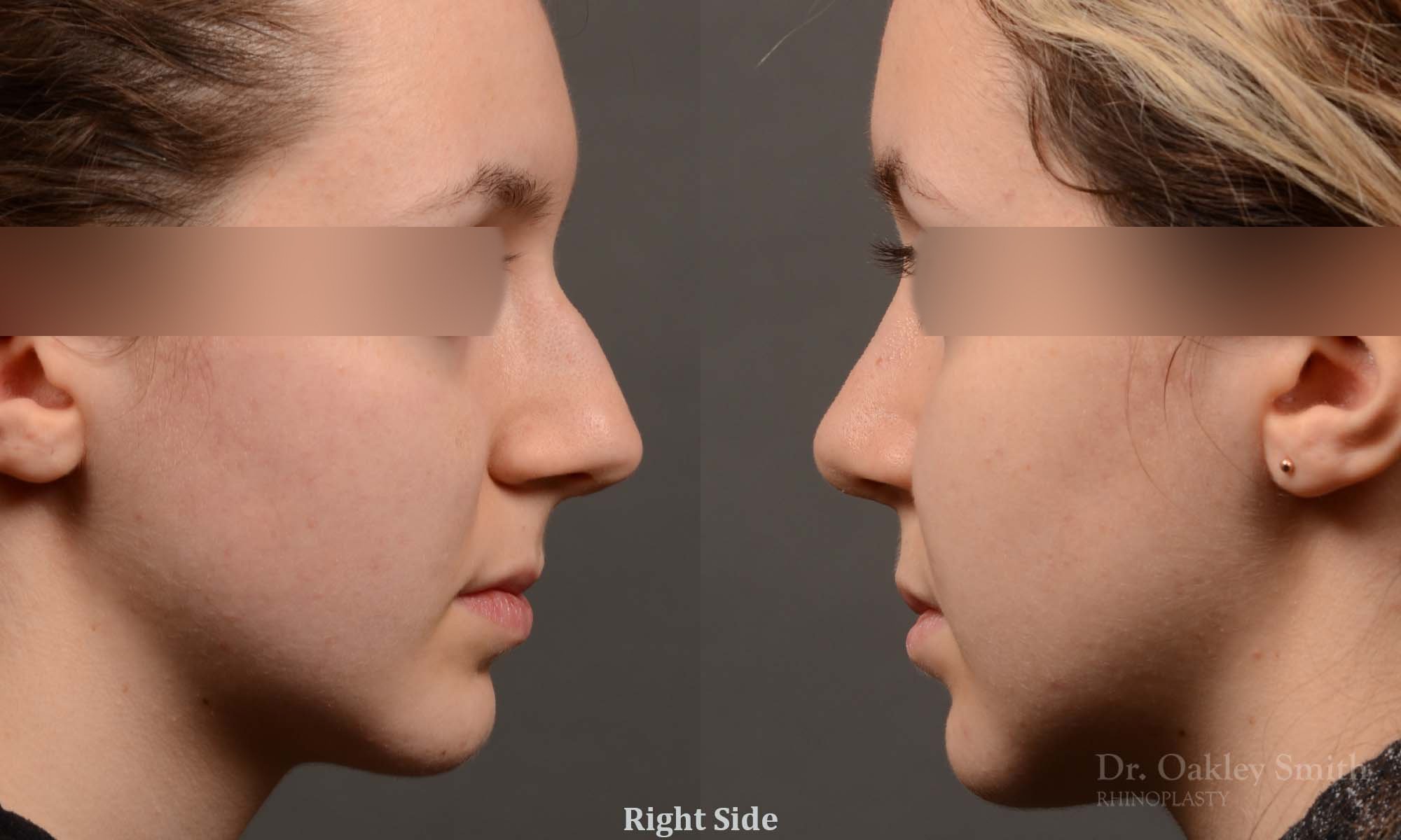 326: Female Rhinoplasty, Dorsal Hump, Tip Narrowing Refinement, slightly Crooked