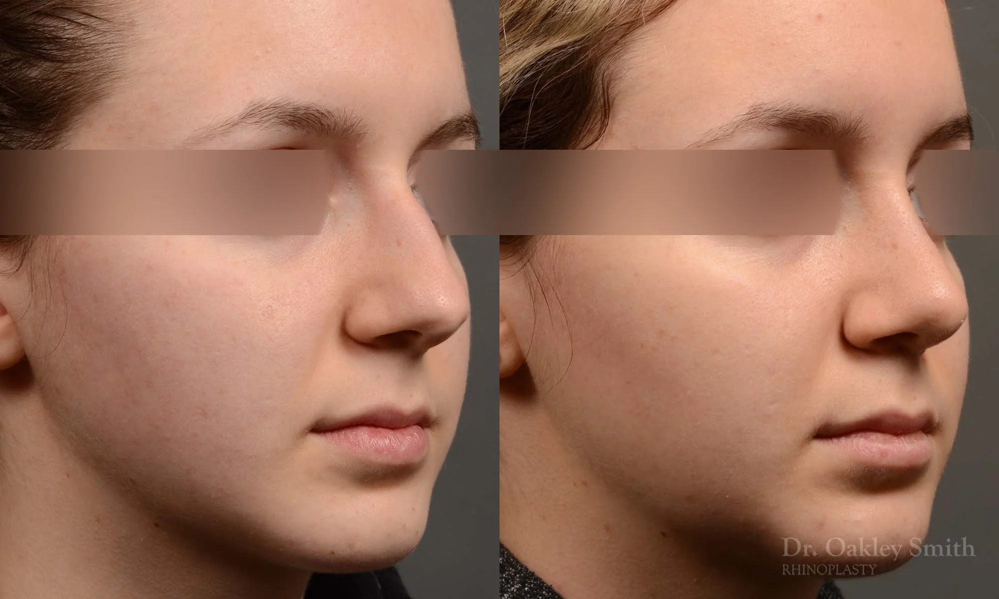 326B-rhinoplasty-dr-oakley-smith-toronto-nose-job.jpg