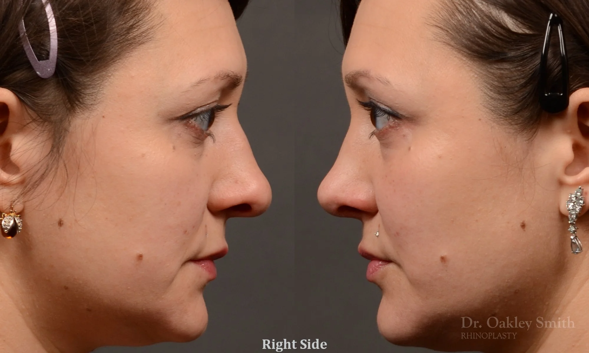 505C-rhinoplasty-dr-oakley-smith-toronto-top-surgeon-nose-job.jpg
