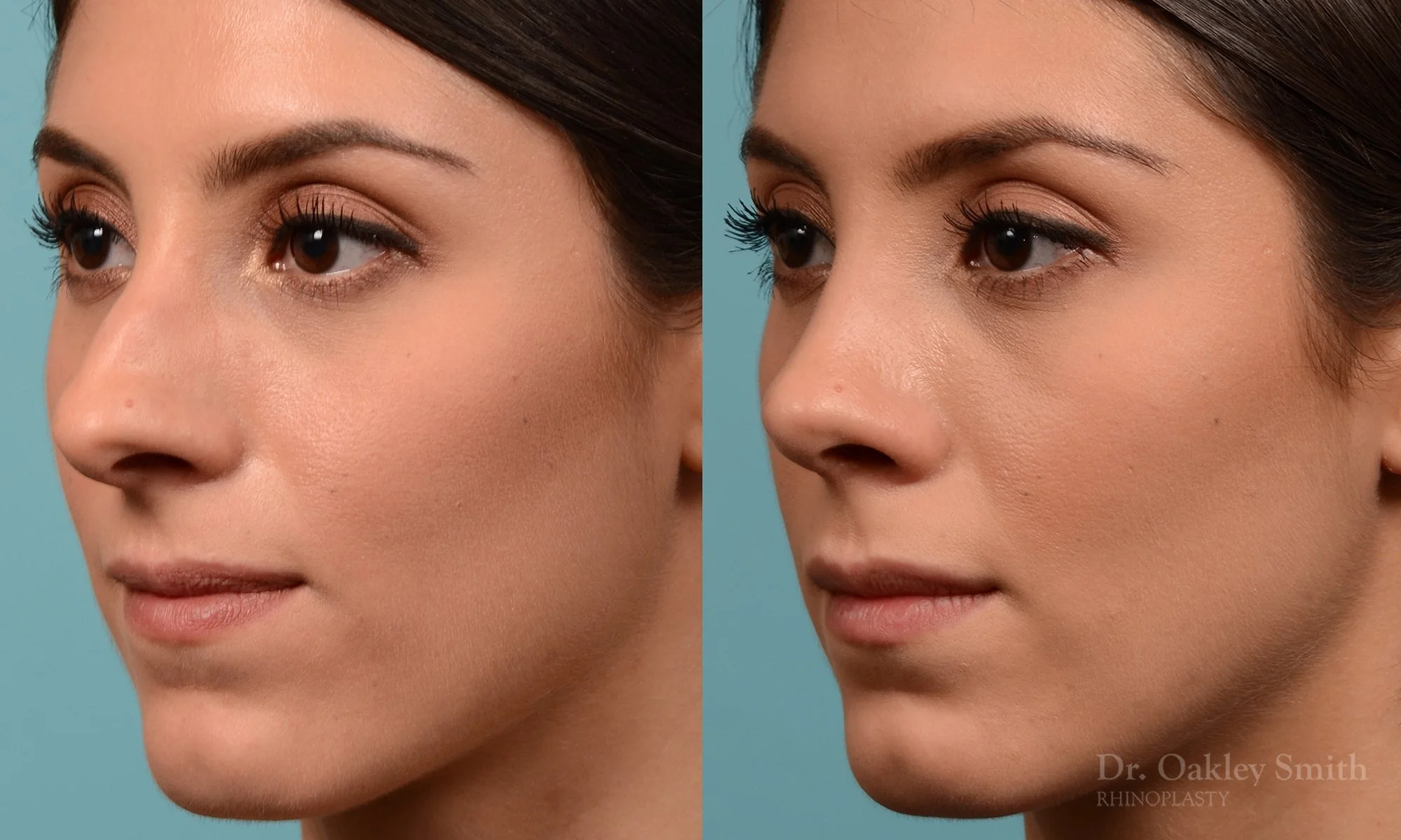 229D-rhinoplasty-oakley-smith-toronto-nose-job-straight-nose-bridge-1.jpg