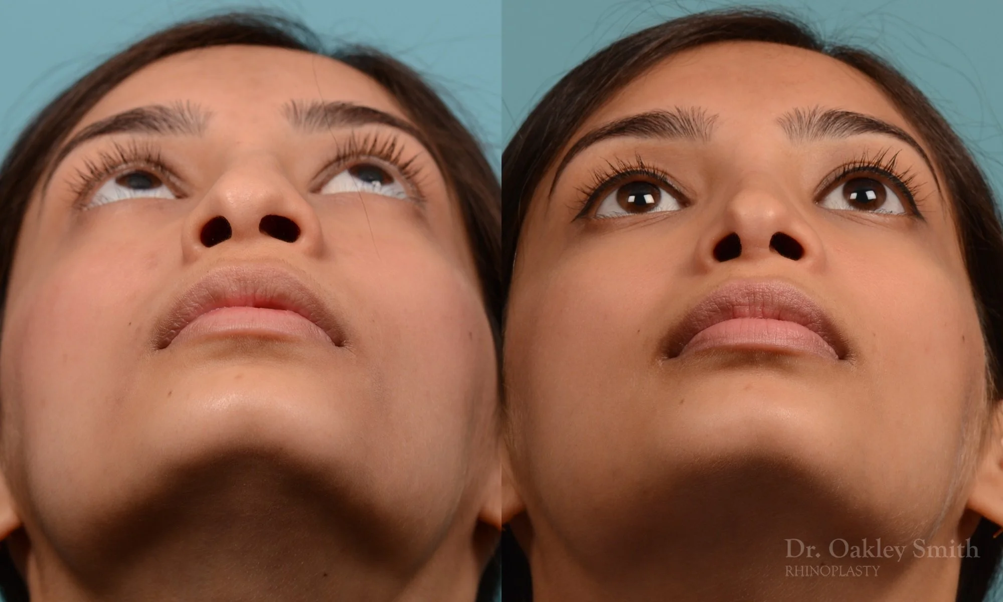 272.5F-rhinoplasty-dr-oakley-smith-toronto-nose-job.jpg