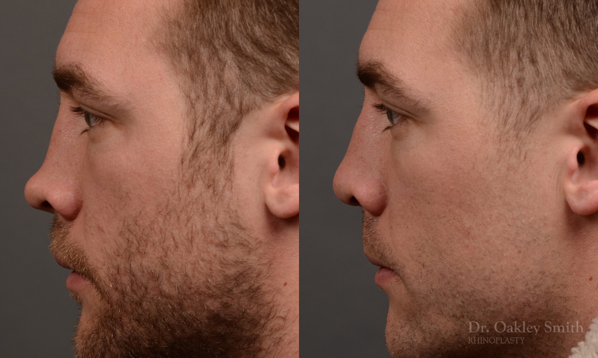 388E-rhinoplasty-dr-oakley-smith-toronto-nose-job.jpg