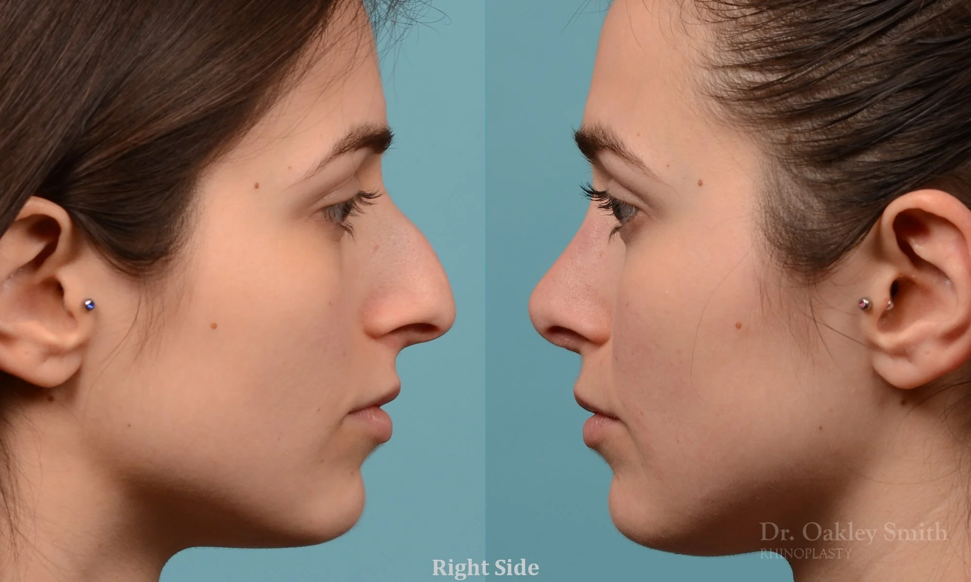 289: Female Rhinoplasty, Large Dorsal Hump, Tip Narrowing Refinement