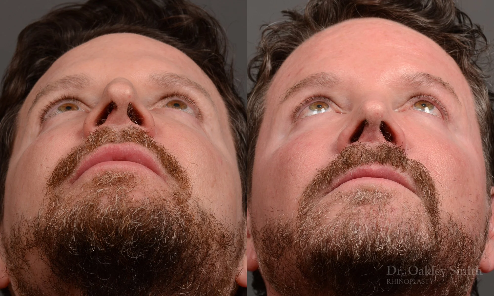 Case 560, Dr. Oakley Smith, male rhinoplasty, 12 months after surgery, submental view
