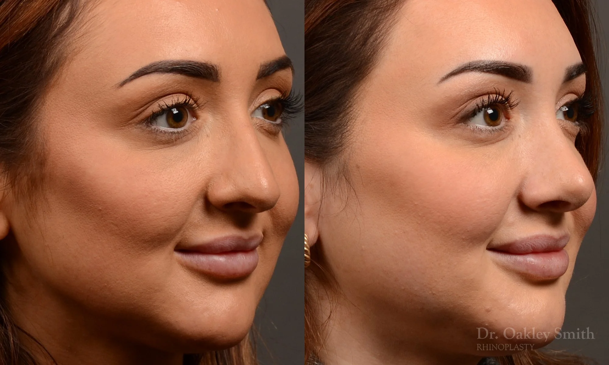 502B-rhinoplasty-dr-oakley-smith-toronto-top-surgeon-nose-job.jpg