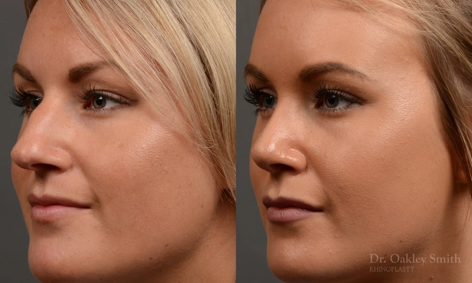 336D-rhinoplasty-dr-oakley-smith-toronto-nose-job.jpg