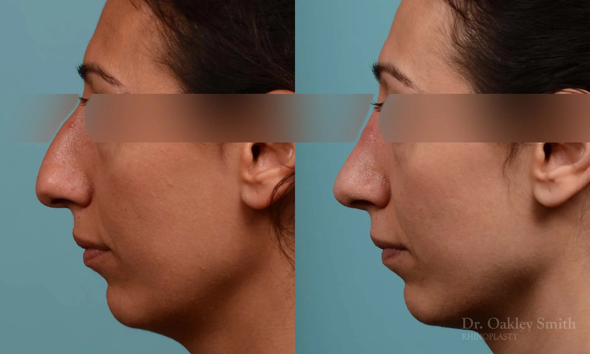 273E-rhinoplasty-dr-oakley-smith-toronto-nose-job.jpg