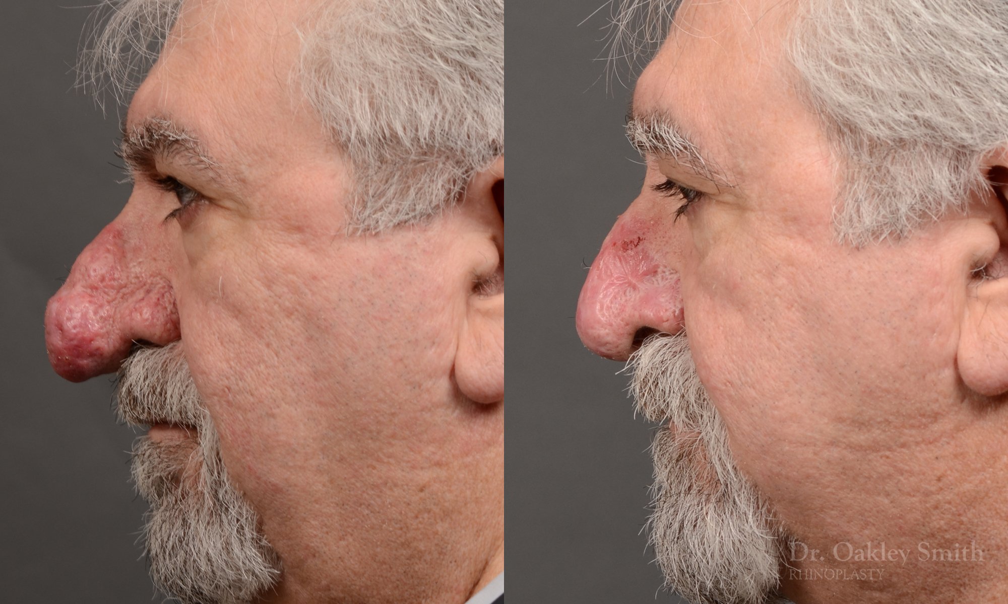 Case 562, Dr. Oakley Smith, rhinophyma rhinoplasty, 12 months after surgery, left profile view