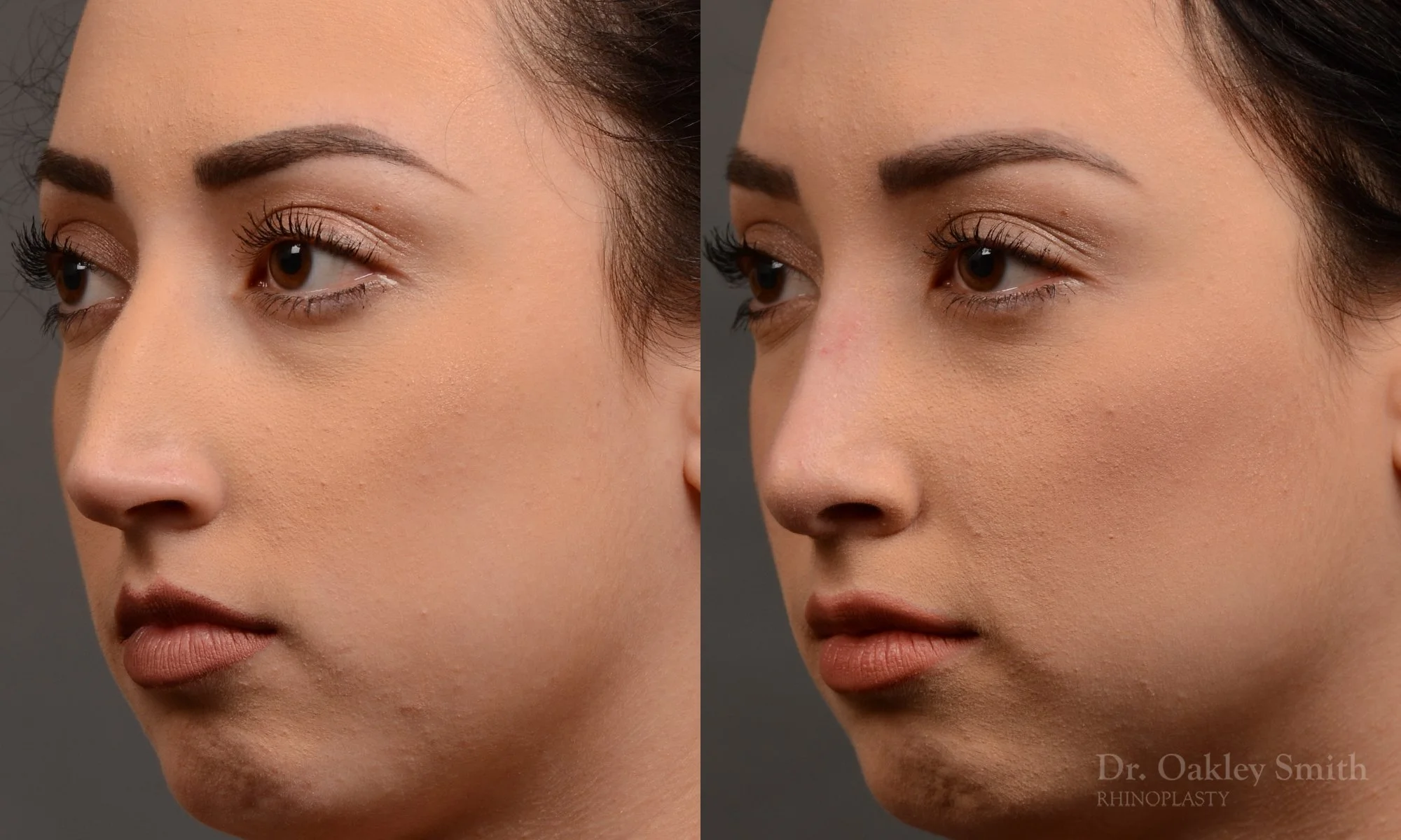 340.1D-rhinoplasty-dr-oakley-smith-toronto-nose-job.jpg