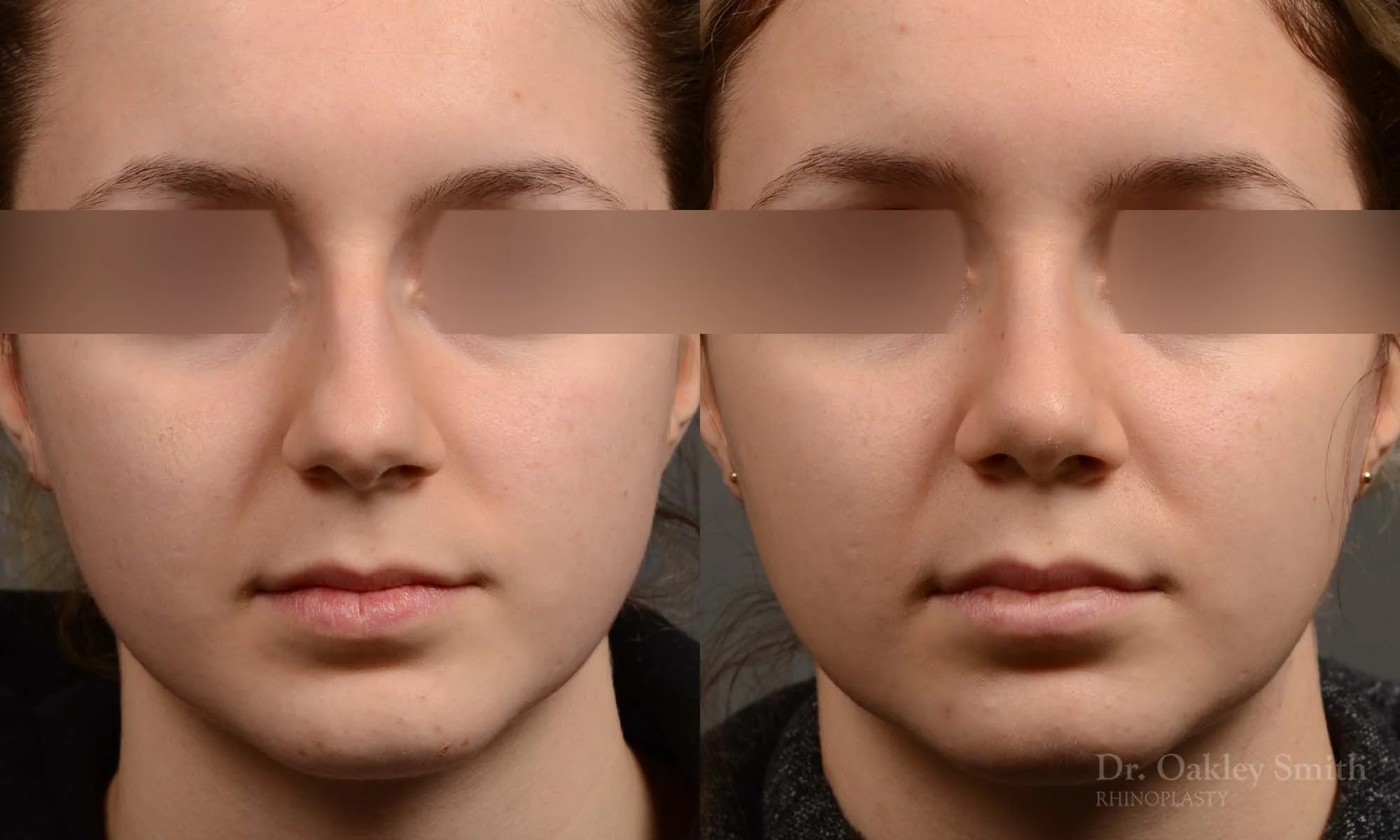 326A-rhinoplasty-dr-oakley-smith-toronto-nose-job.jpg