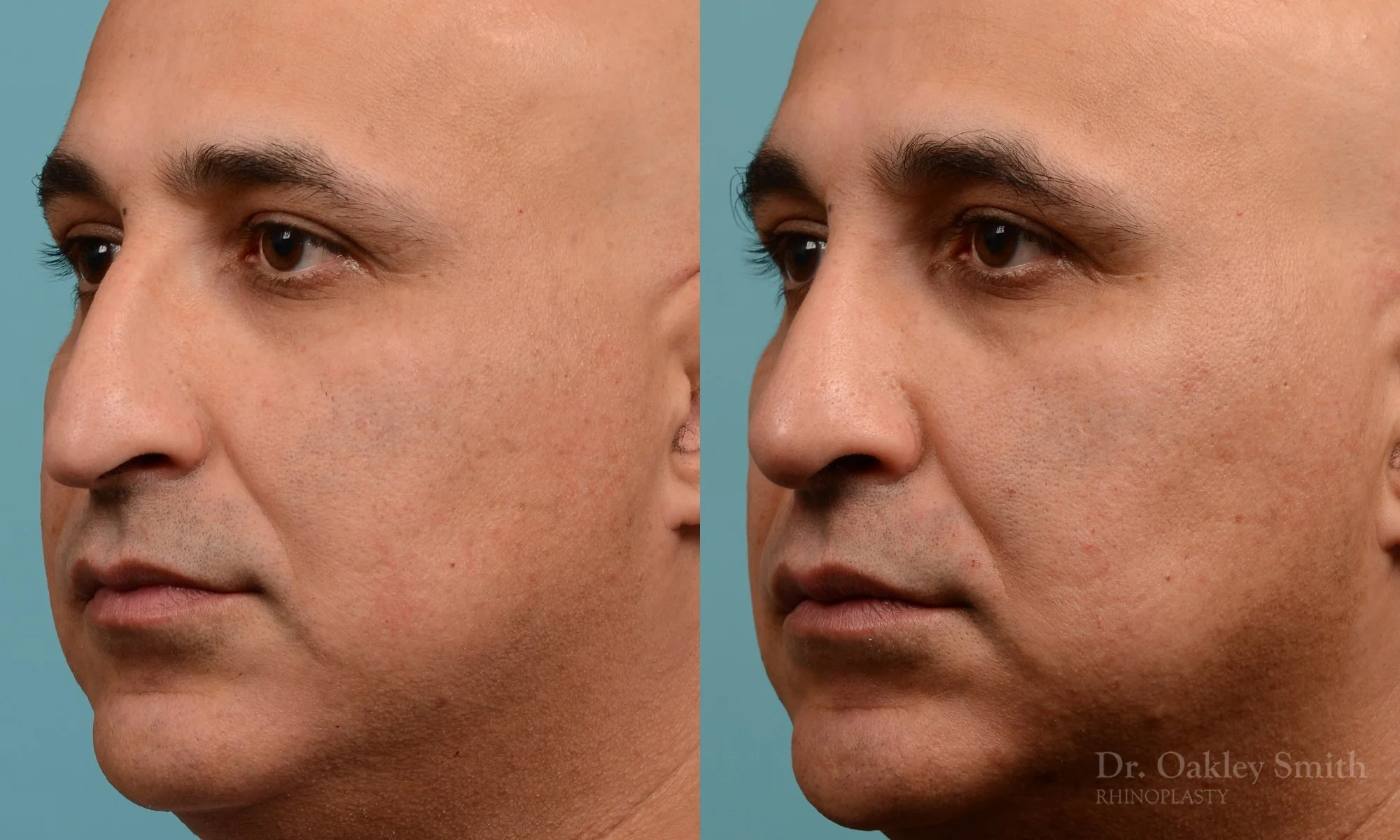 349.1D-rhinoplasty-dr-oakley-smith-toronto-nose-job.jpg
