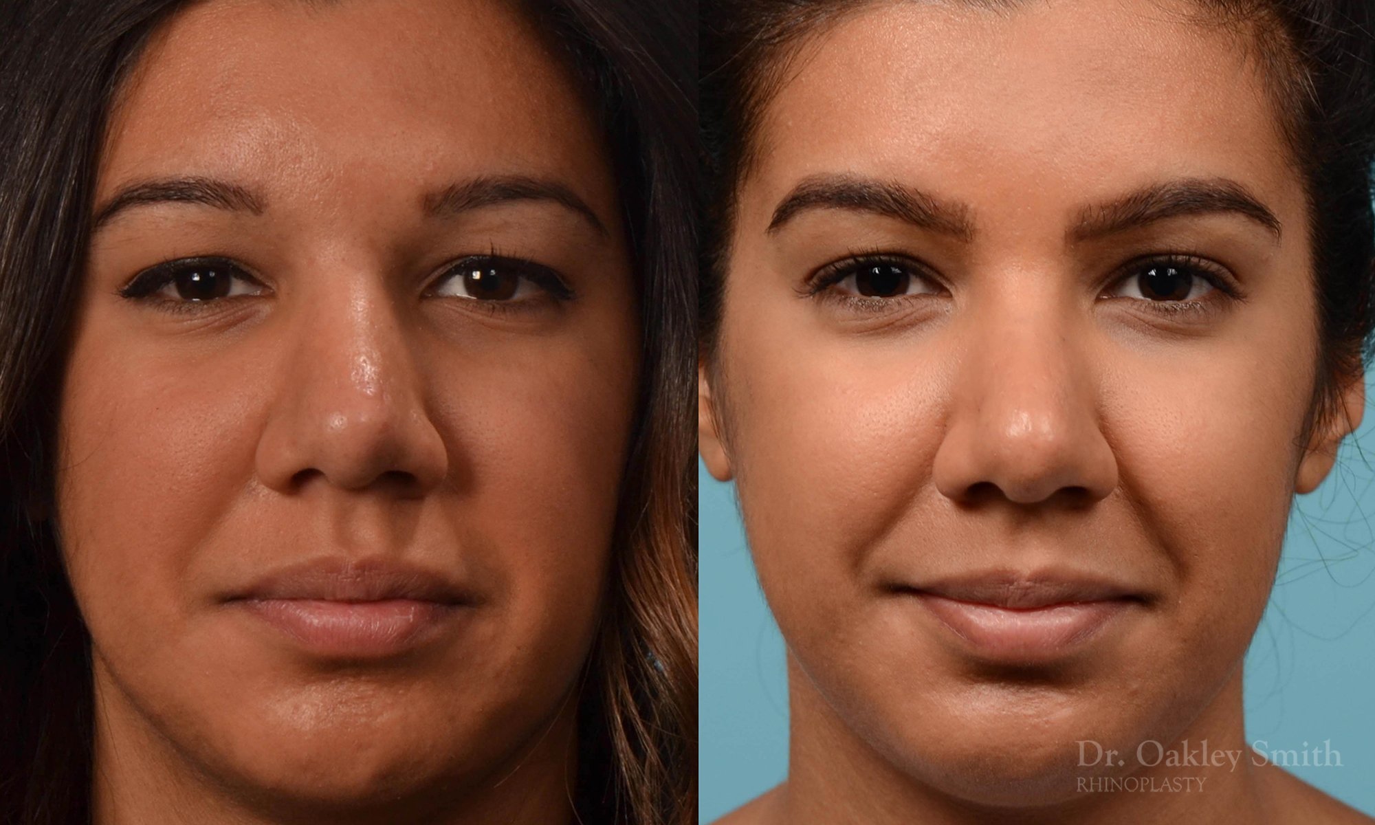 237A-rhinoplasty-dr.-oakley-smith-1.jpg