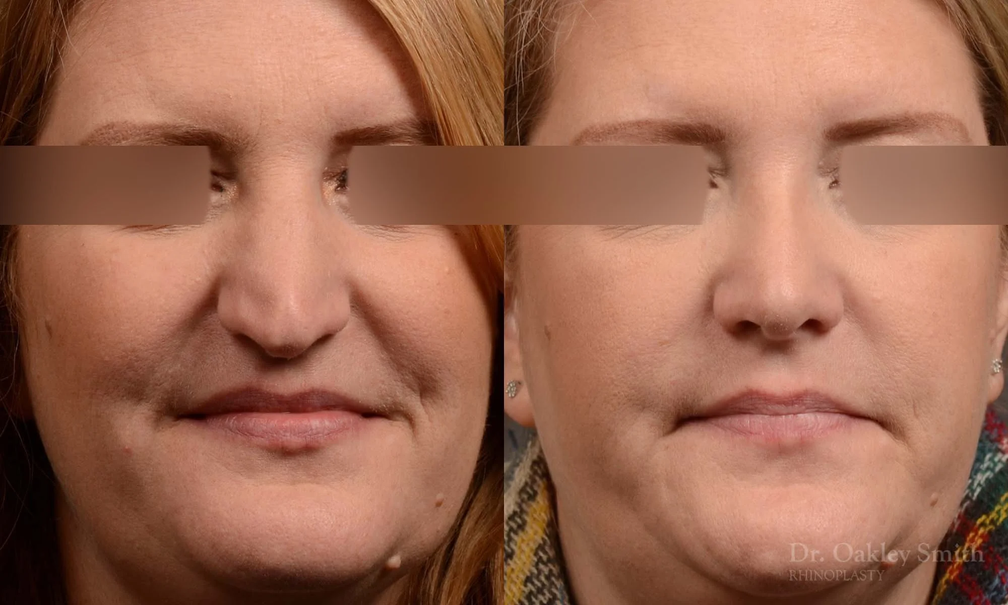489A-rhinoplasty-dr-oakley-smith-toronto-top-surgeon-nose-job.jpg