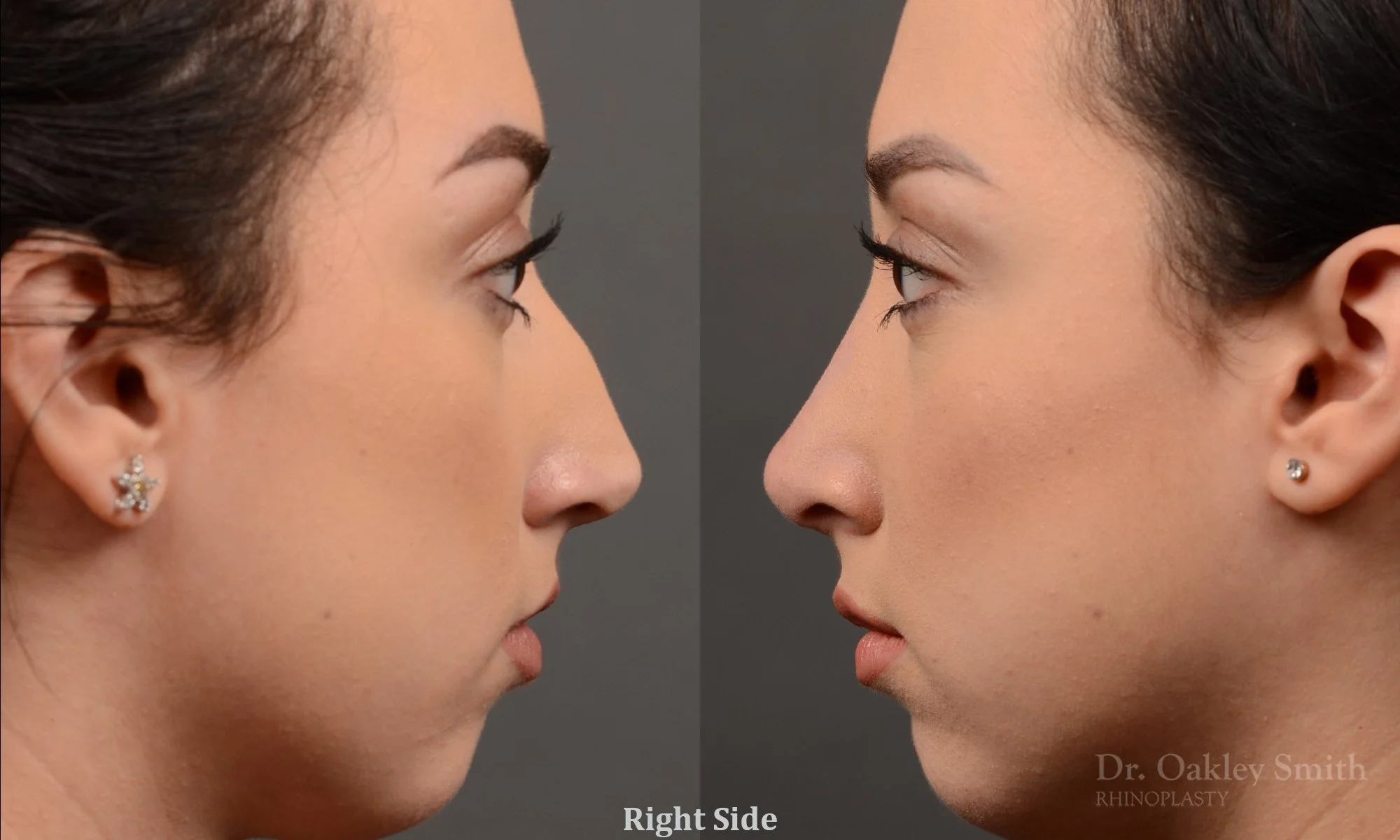 340.1C-rhinoplasty-dr-oakley-smith-toronto-nose-job.jpg