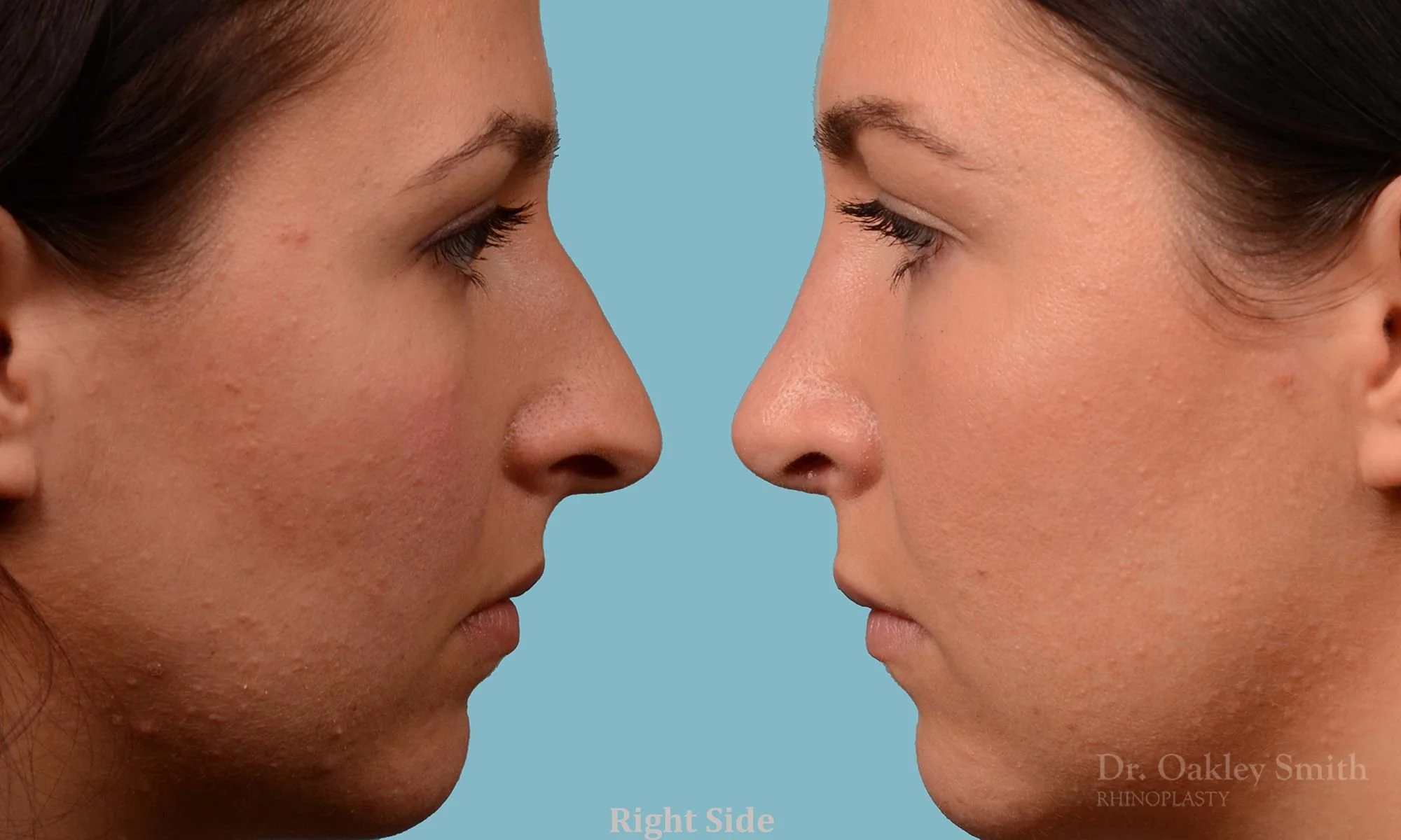 209: Female Rhinoplasty, Dorsal Ridge, Tip Narrowing Refinement