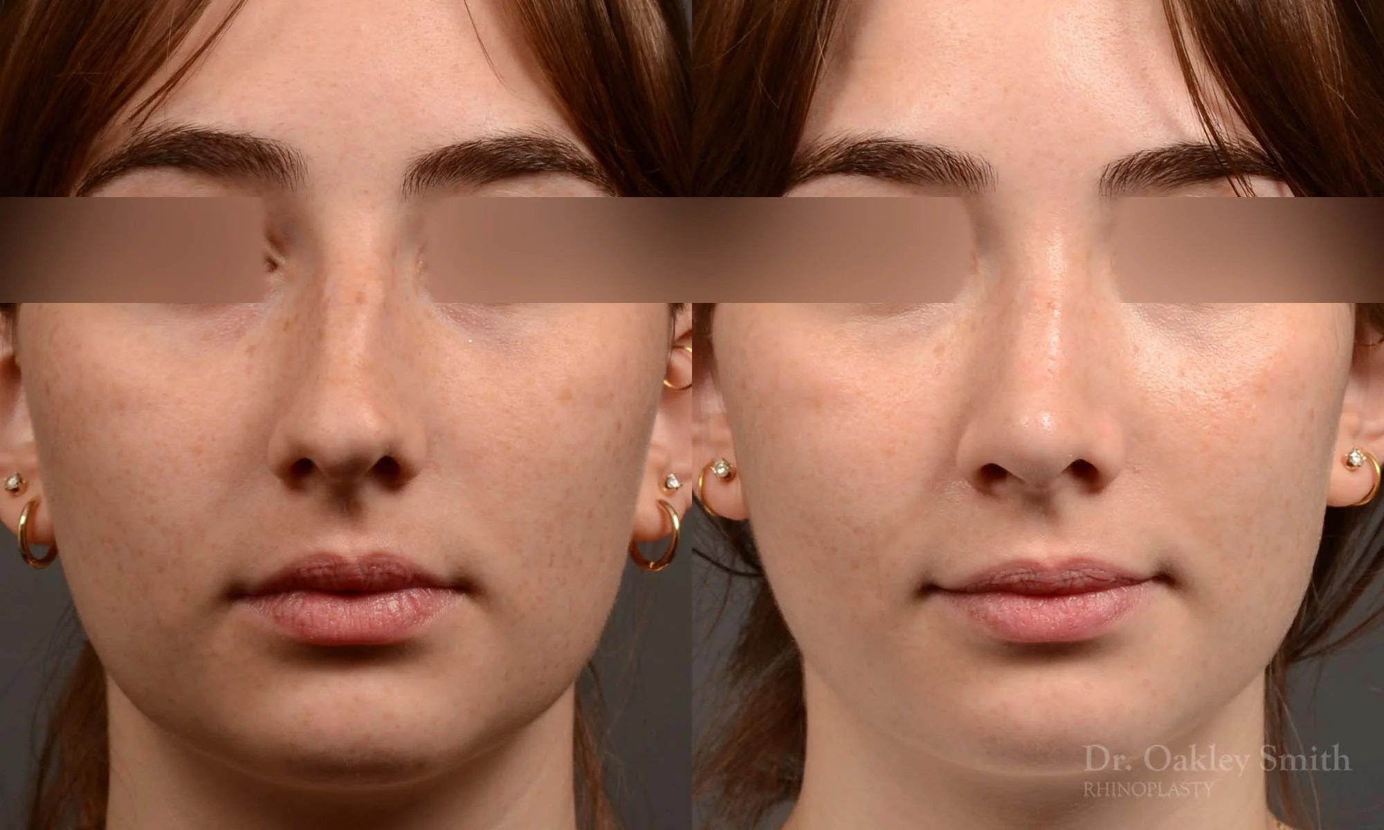 551A-rhinoplasty-nose-job-toronto-nose-surgeon-dr-oakley-smith.jpg