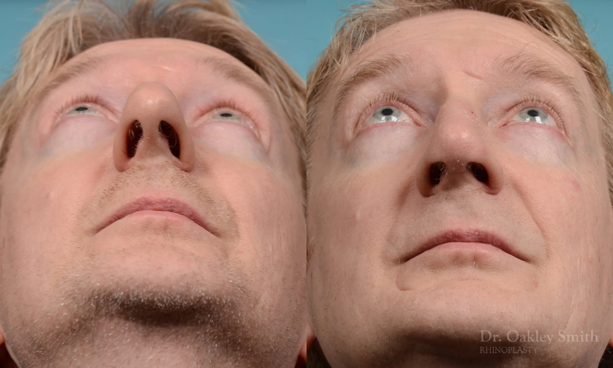 276F-rhinoplasty-dr-oakley-smith-toronot-nose-job.jpg