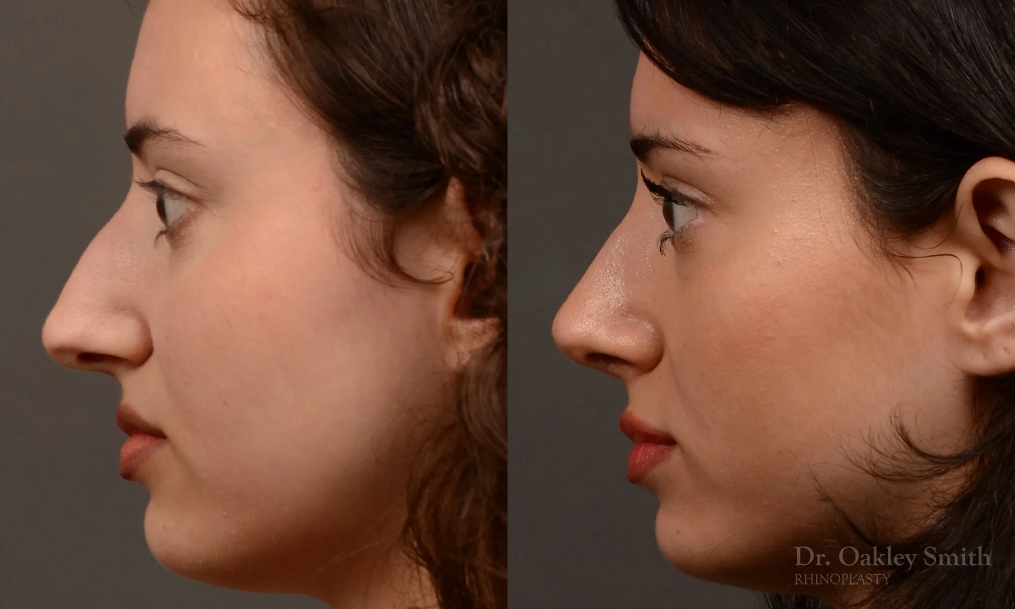 547E-rhinoplasty-dr.-oakley-smith-top-rhino-surgeon-toronto.jpg