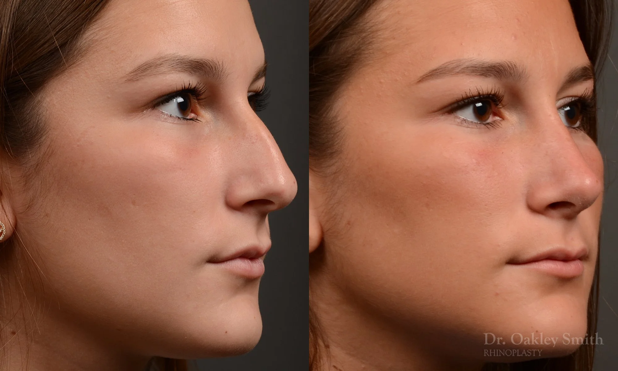 517B-rhinoplasty-dr-oakley-smith-toronto-top-surgeon-nose-job.jpg