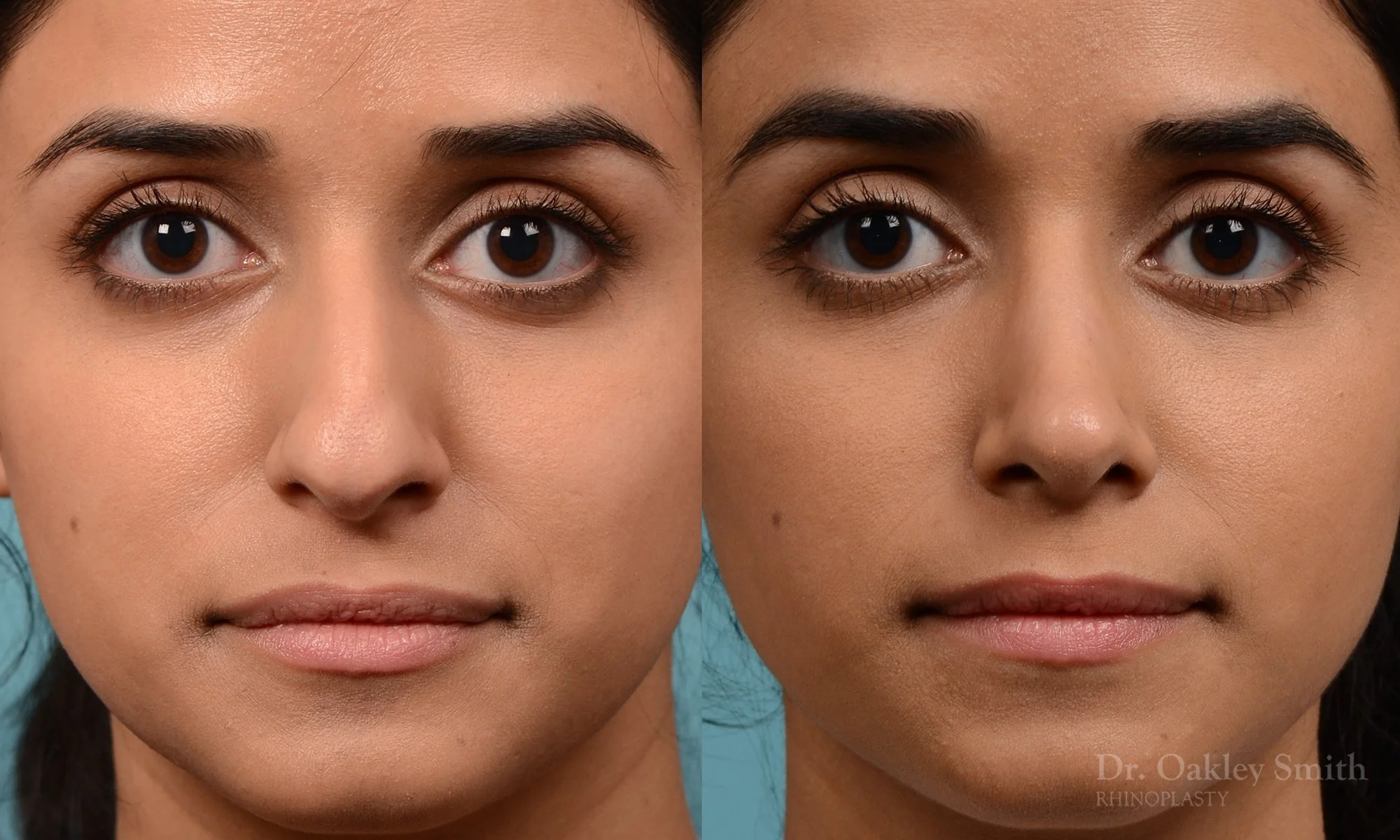228A-nose-job-rhinoplasty-dr-oakley-smith-toronto-bump-on-the-nose-bridge-bump-4.jpg