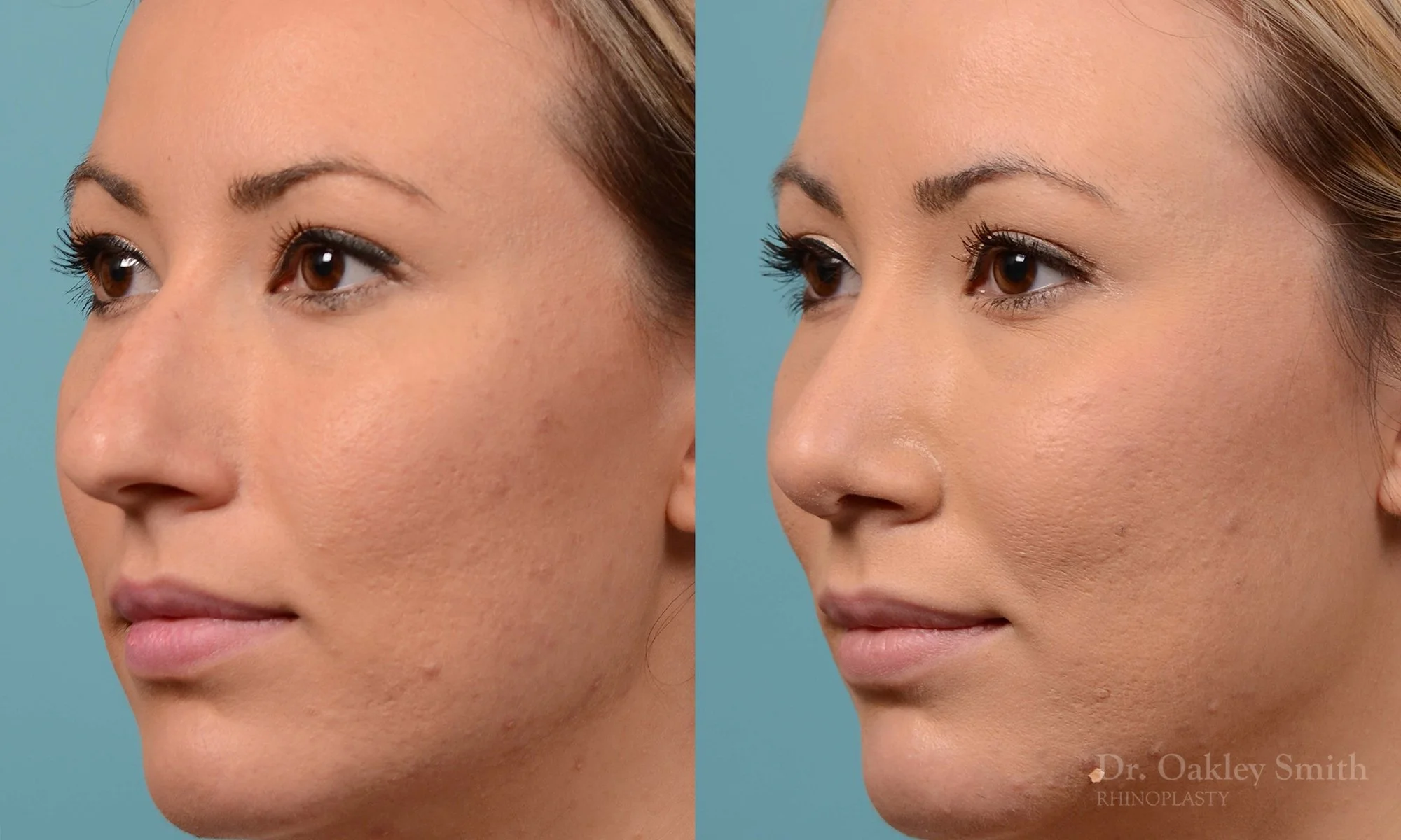 213D-rhinoplasty-toronto-dr-oakley-smith-big-nose-nose-job-curved-straight-profile-columellar-raised-1.jpg