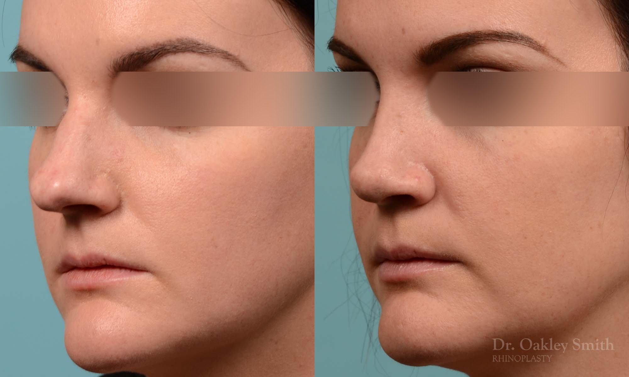 252D-rhinoplasty-dr-oakley-smith-toronto-nose-job.jpg