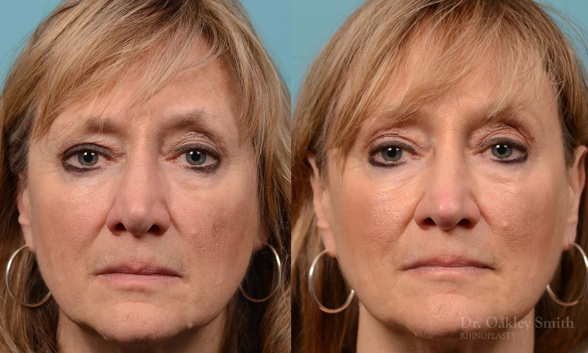 225A-rhinoplasty-dr-oakley-smith-nose-job-curved-nose-columellar-long-nose-1.jpg